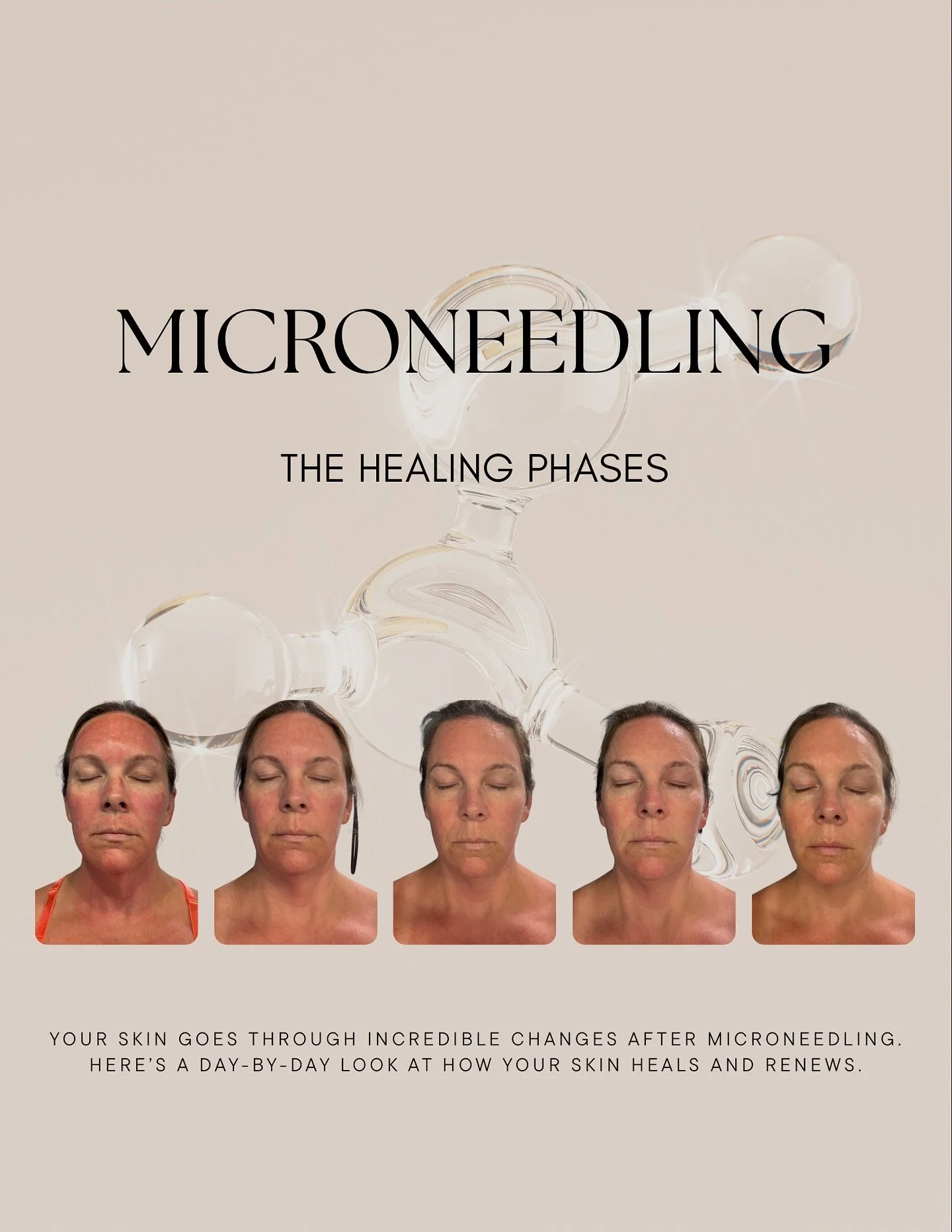 Let&rsquo;s walk through this client&rsquo;s healing phases and learn what Microneedling is all about💉 If you&rsquo;re interested in this rejuvenation treatment here&rsquo;s what to expect🤍

Microneedling isn&rsquo;t just a treatment &mdash; it&rsq