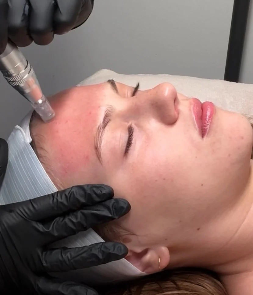 Microneedling with AnteAGE Stem Cells🧬

This advanced treatment pairs the collagen-boosting power of microneedling with regenerative AnteAGE growth factors and stem cell cytokines. The result? Faster healing, reduced downtime, and visibly smoother, 