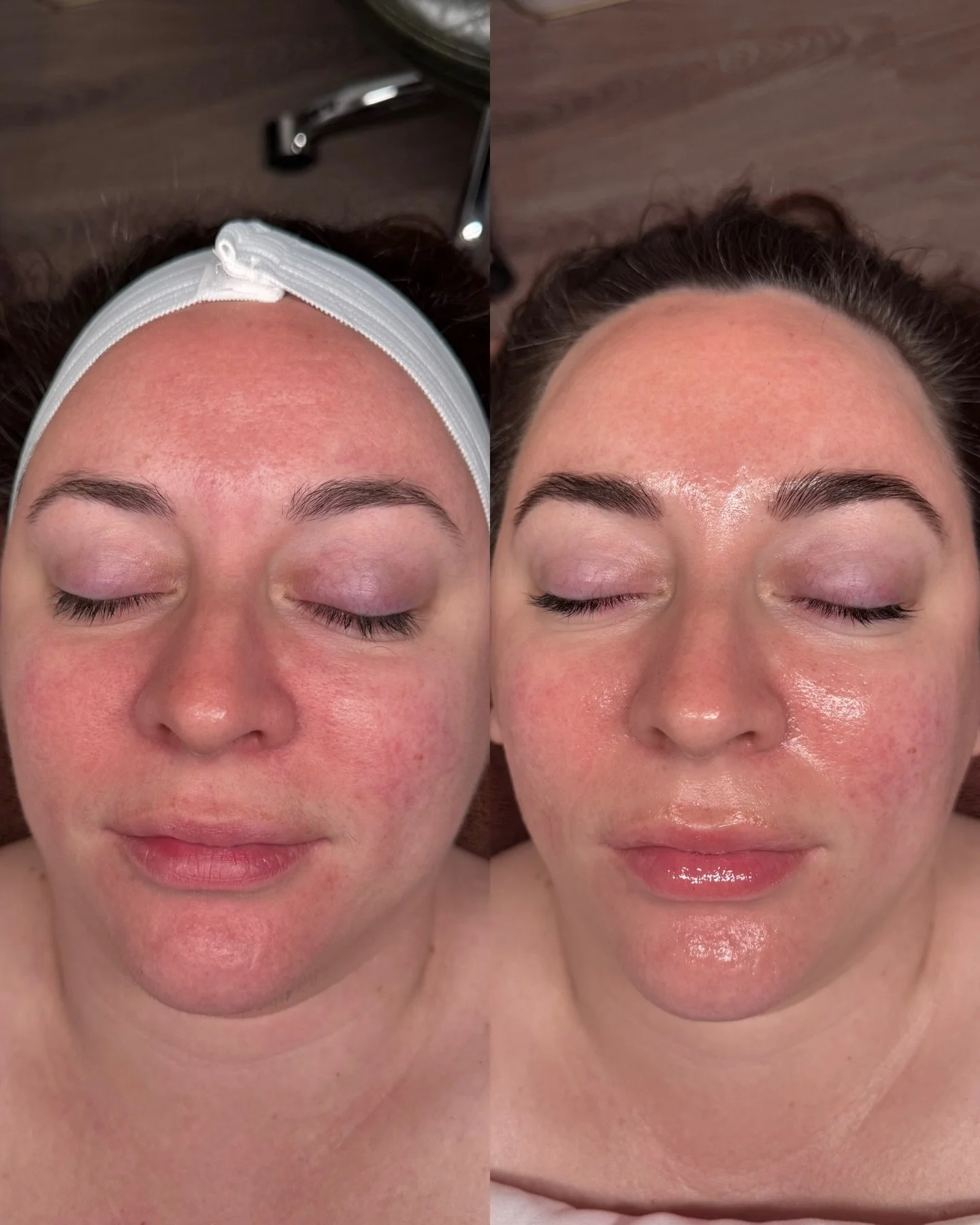 Results from our Soothing Ritual🤍

Immediate, visible calm ✨

This is what barrier-first, corrective skincare looks like in real time.

Our Soothing Ritual is designed to reduce redness, calm inflammation, and restore balance to compromised skin&mda