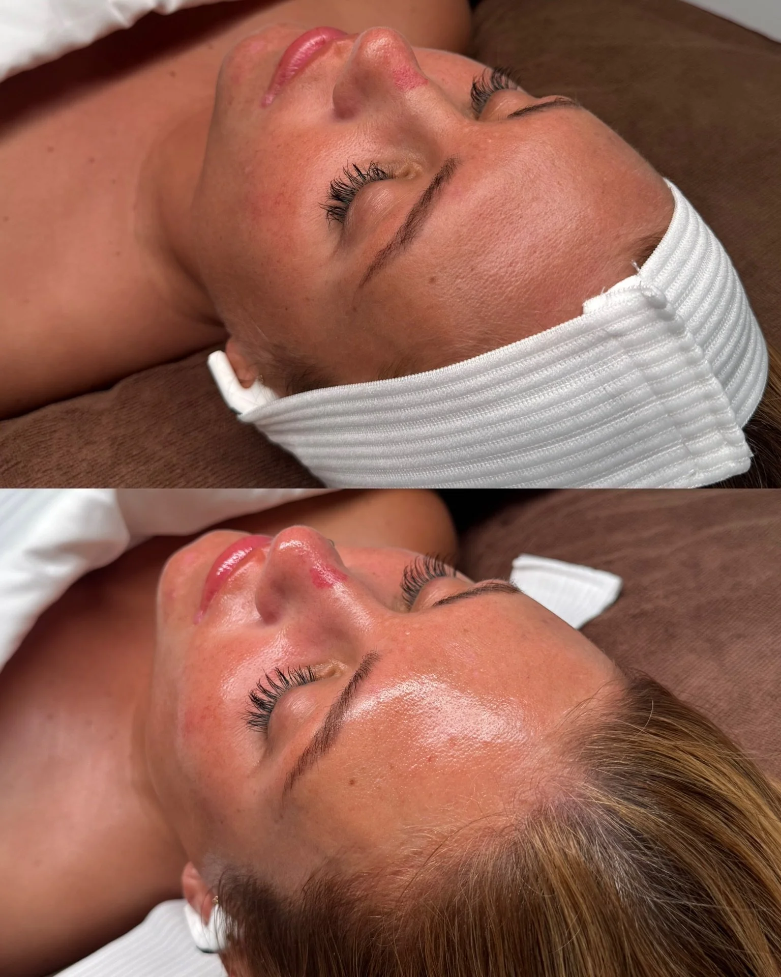 Immediate results from our PDRN Infusion Treatment👏🏼

Insane glow, hydration, and skin rejuvenation in just one treatment🔥

#pdrn #skinrejuvenation #newtreatment #favorite #botanicaskinwellness