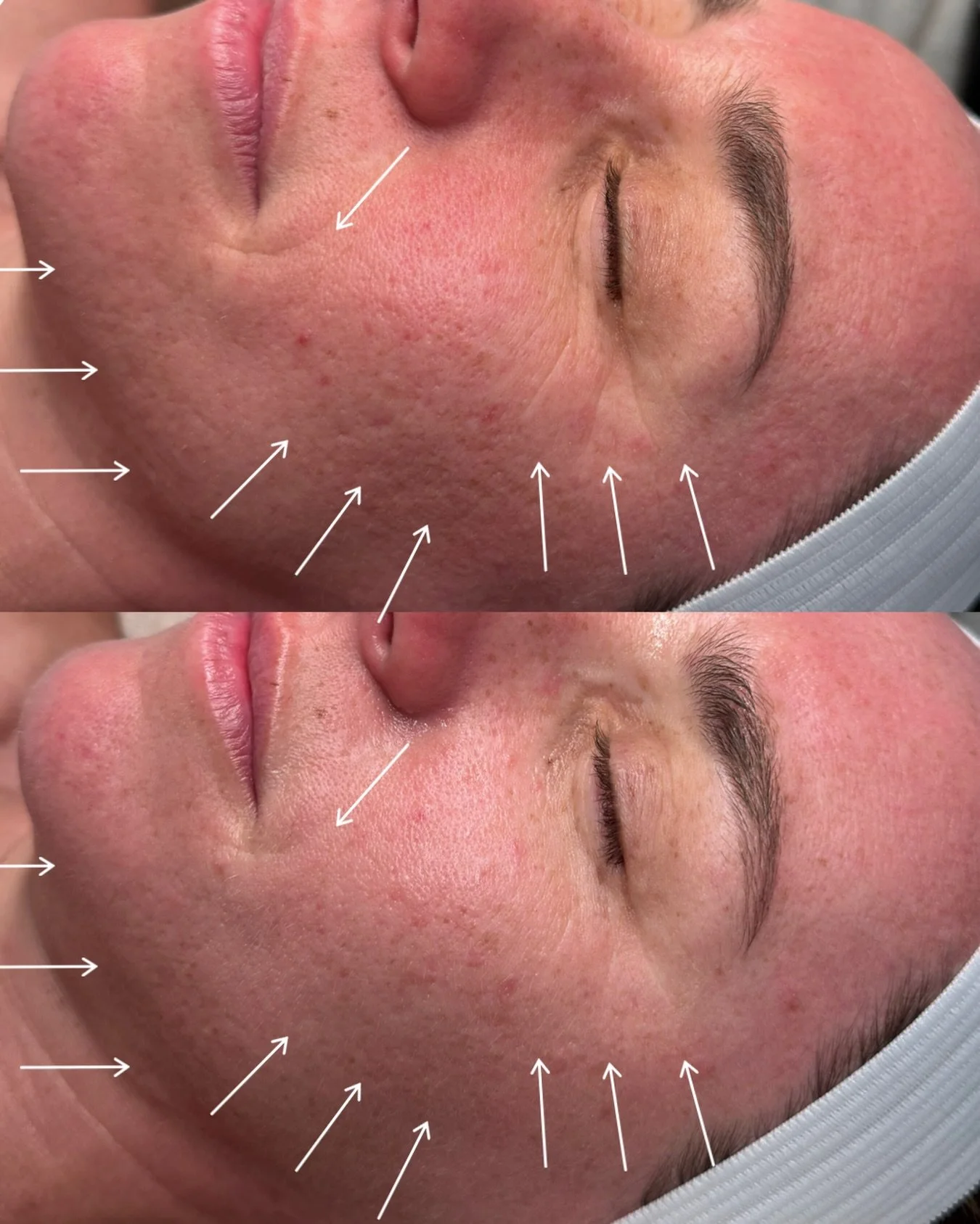 One session✨ Real change ✨

This beautiful client had her second session today and we&rsquo;re so excited to see the continued improvement in her skin! 

➡️ Smoother texture
➡️ Reduced acne scarring
➡️ Refined pores
➡️ Improved overall skin tone + cl