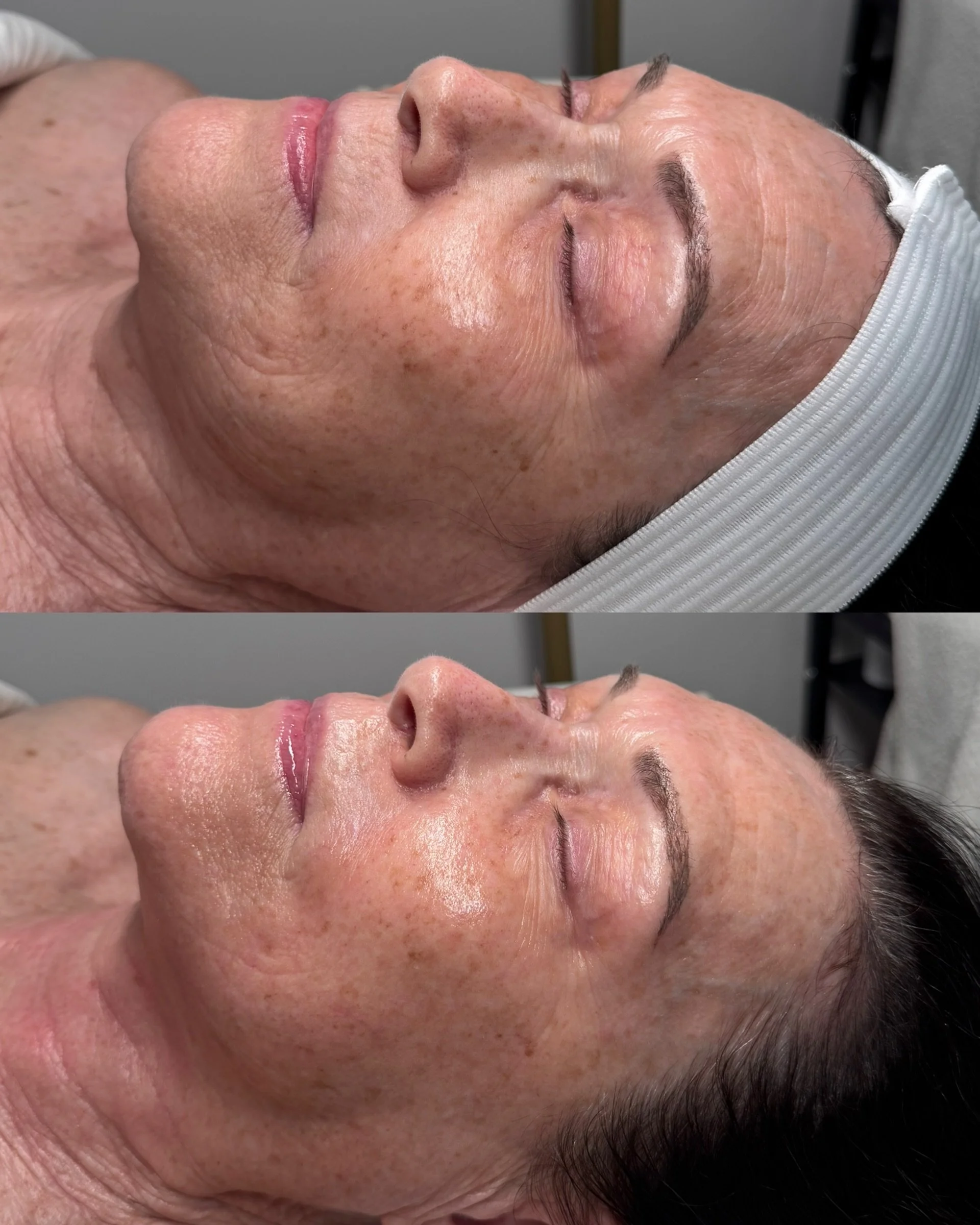 My beautiful aunt came in today for our new Bio Renewal Collagen Ritual ✨

We started with a customized brightening peel followed by the Dermathod C4 Carboxy Treatment to oxygenate, brighten, and prep the skin for deeper rejuvenation 🌿

We then infu