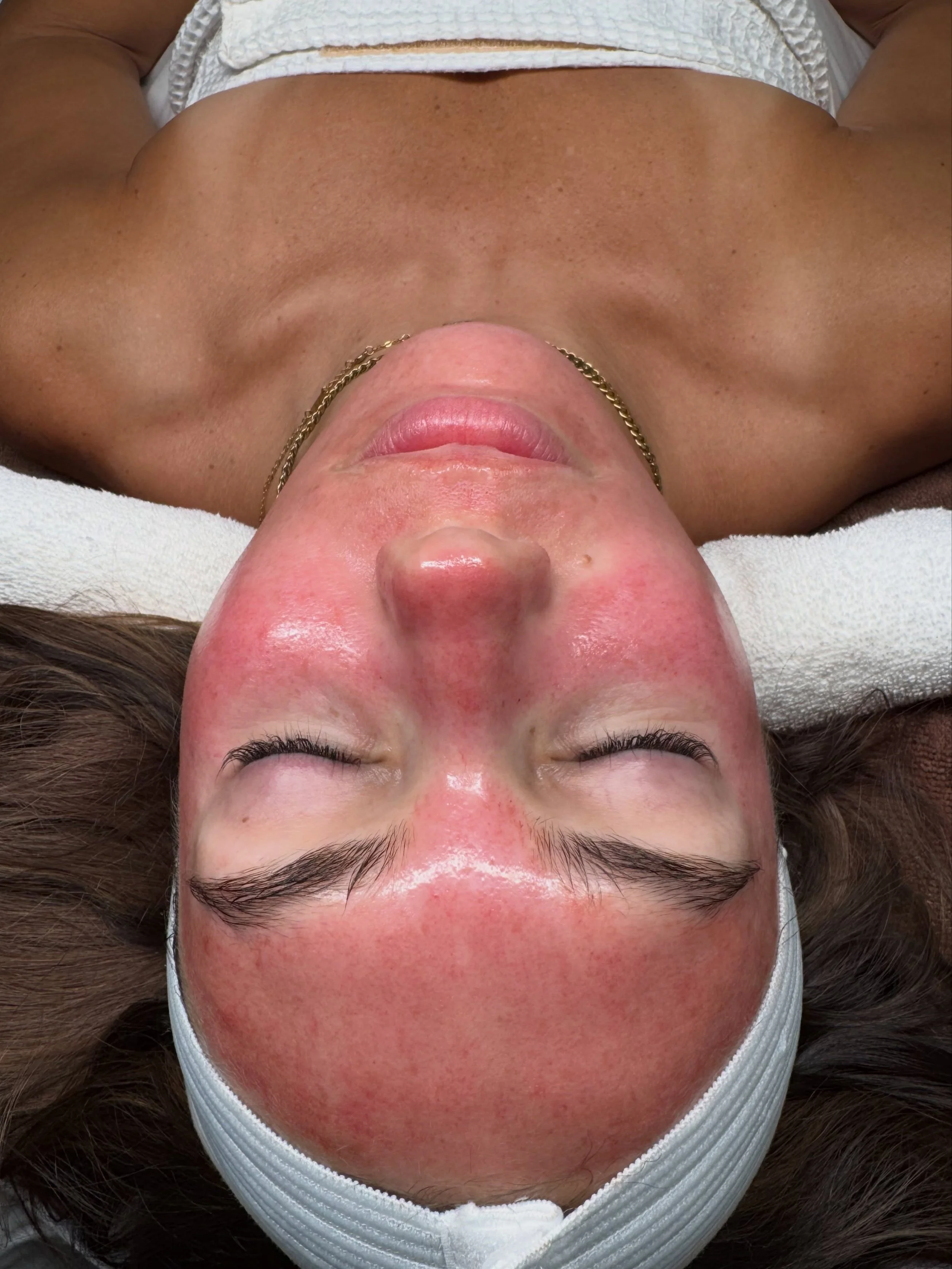 Collagen loading ✨✨✨

Post-microneedling glow with the skin in full repair + renewal mode 🤍

This treatment works by creating controlled microchannels in the skin to stimulate collagen and elastin production while enhancing the absorption of targete
