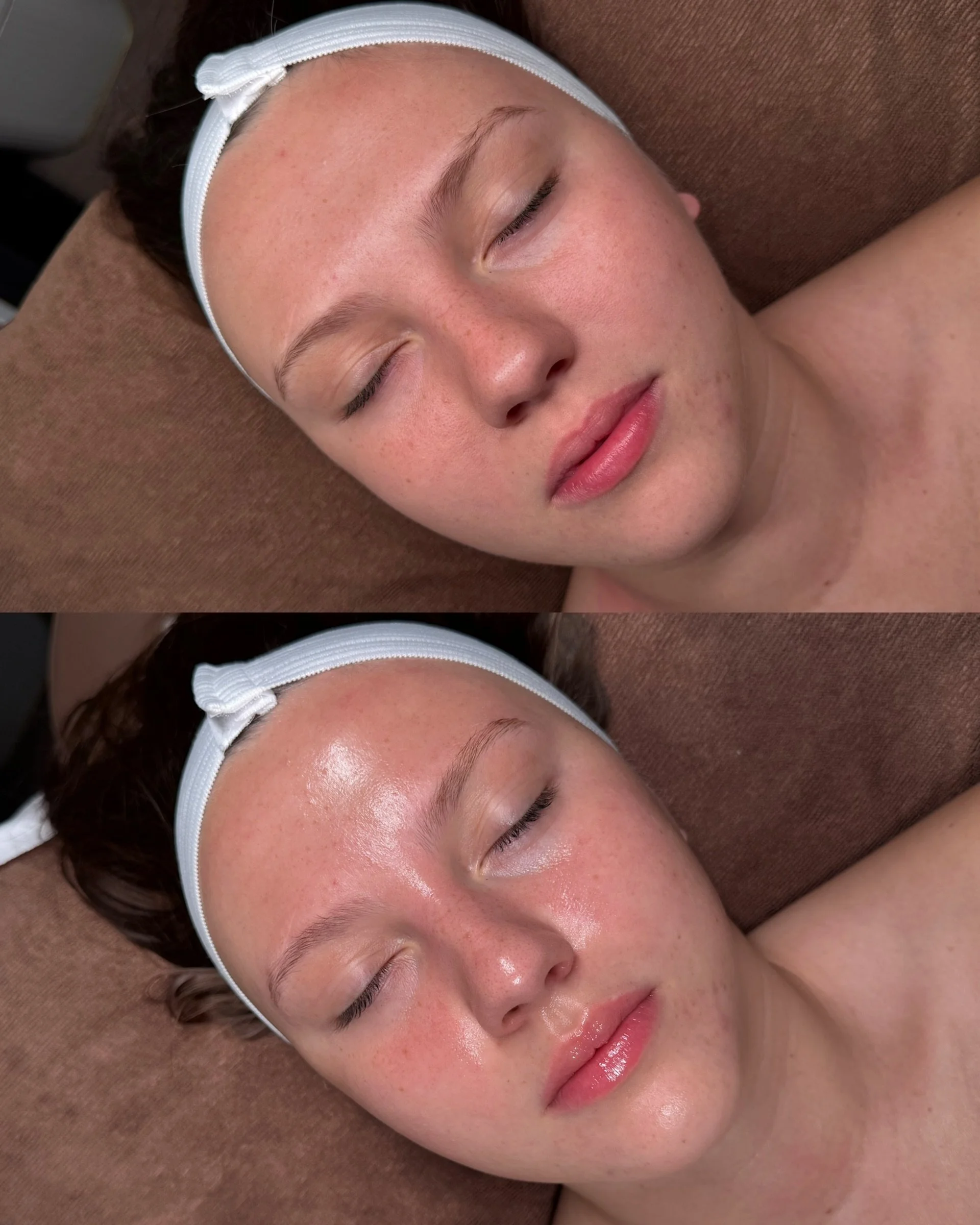 A healthy glow starts with a healthy skin barrier✨

One reason this client is such a great candidate for dermaplaning is that her skin isn&rsquo;t being overstimulated by harsh actives or over-exfoliation. With a strong, balanced barrier, dermaplanin