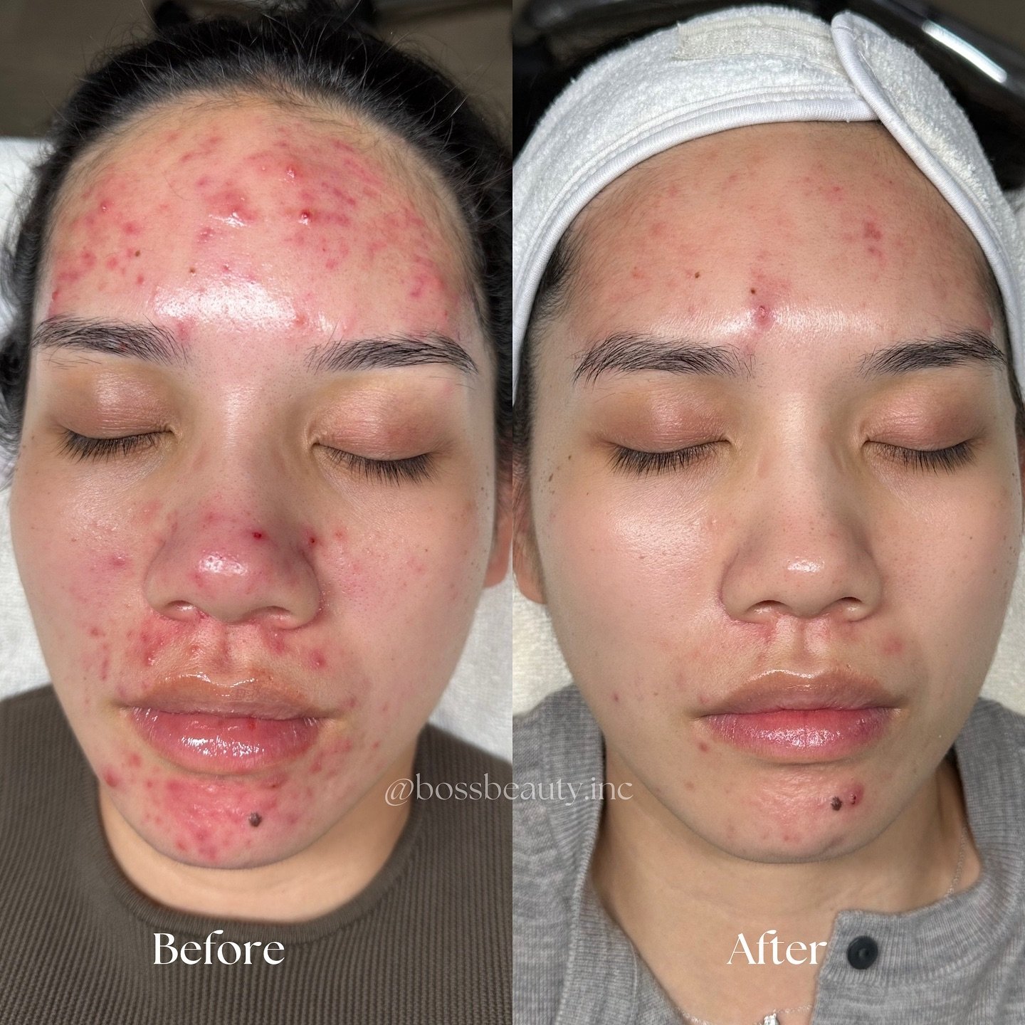 ACNE TRANSFORMATION 🪄 

When my client met me for the first time, her main concern was INFLAMMATION‼️ Not only had she been struggling with inflamed, cystic breakouts&mdash; she was dealing with lots of acne scarring, redness, scabs. 

My client put