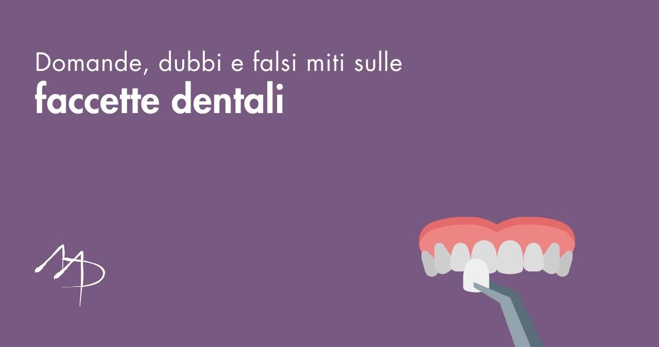 Faccette dentali: domande, dubbi e verità su uno dei trattamenti più discussi