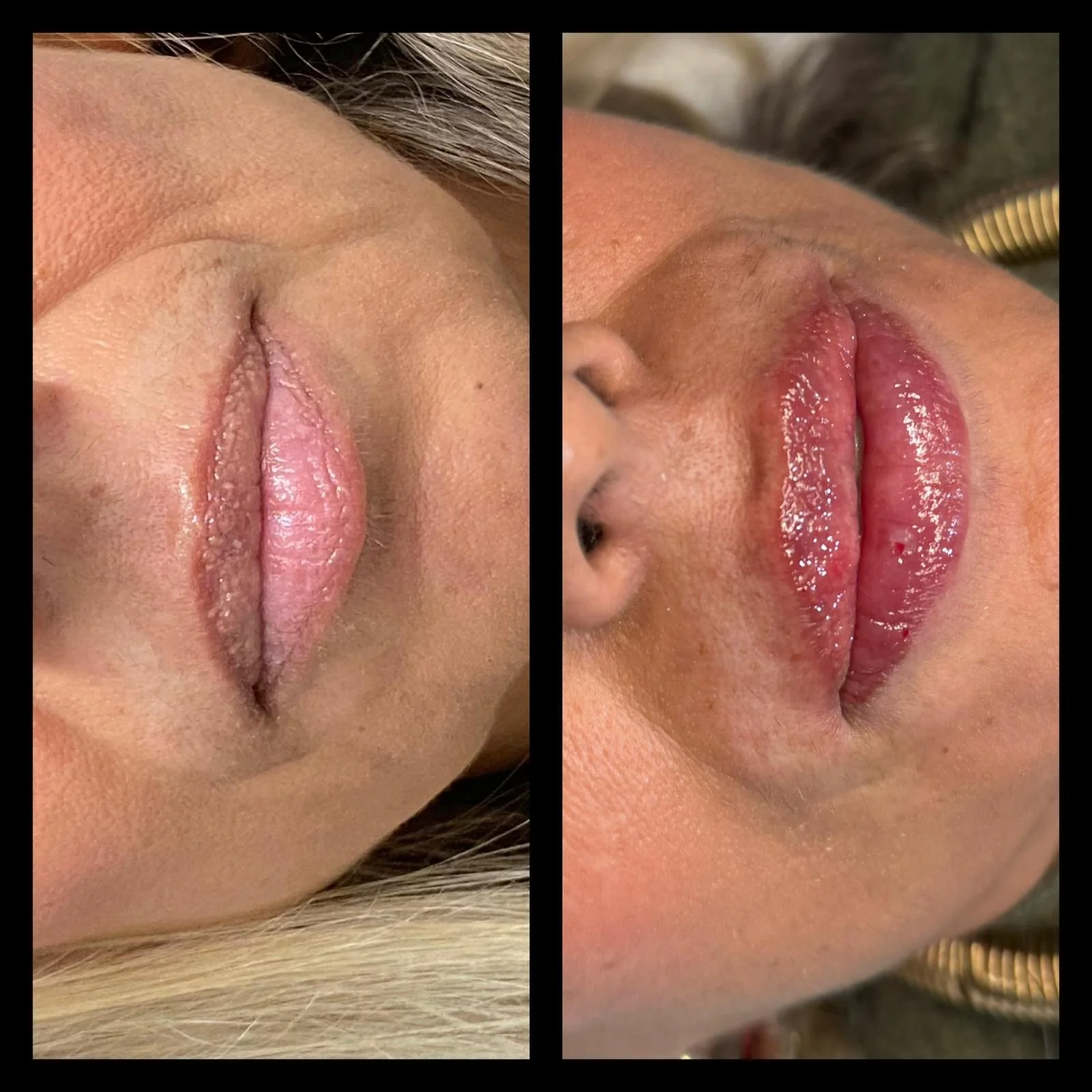 Foto che mette a confronto delle labbra prima e dopo un tarttamento esteticp