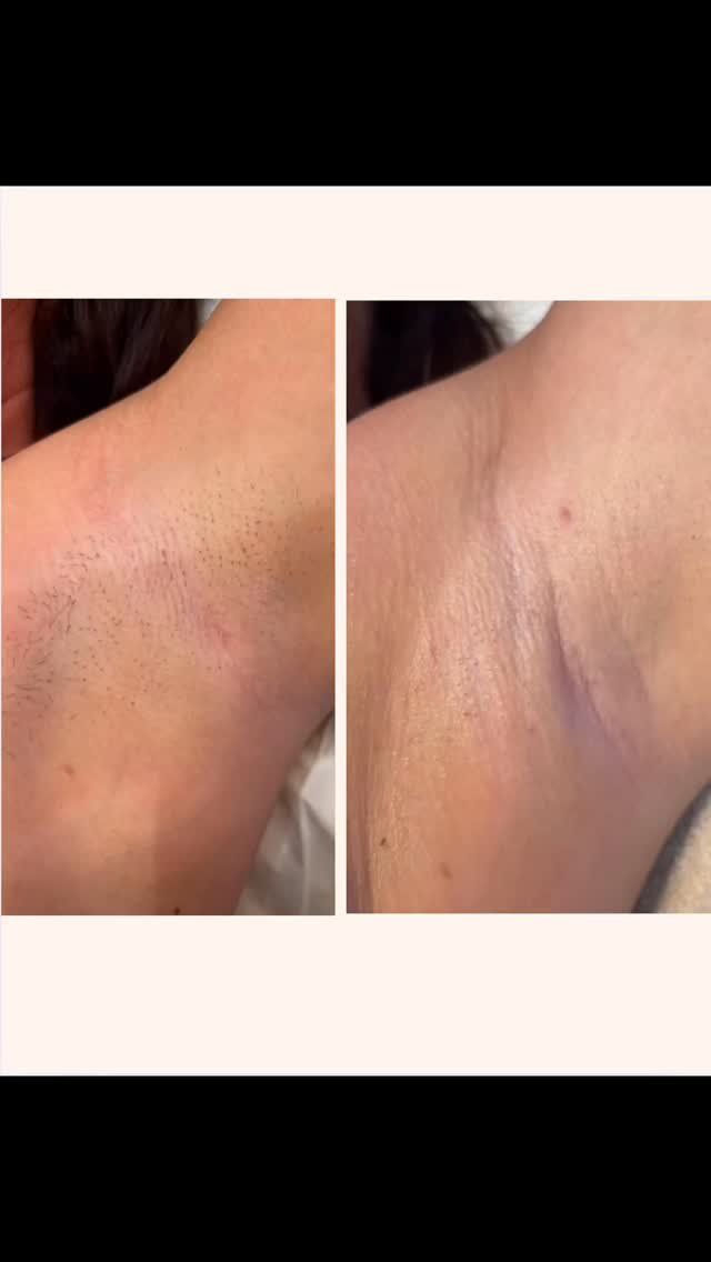 2 sessions into underarm laser hair removal 😬
Previously my client was shaving pretty much everyday and getting growth reappearing within a few hours… her hair was dark and coarse so I was super excited for her to start her laser journey&he