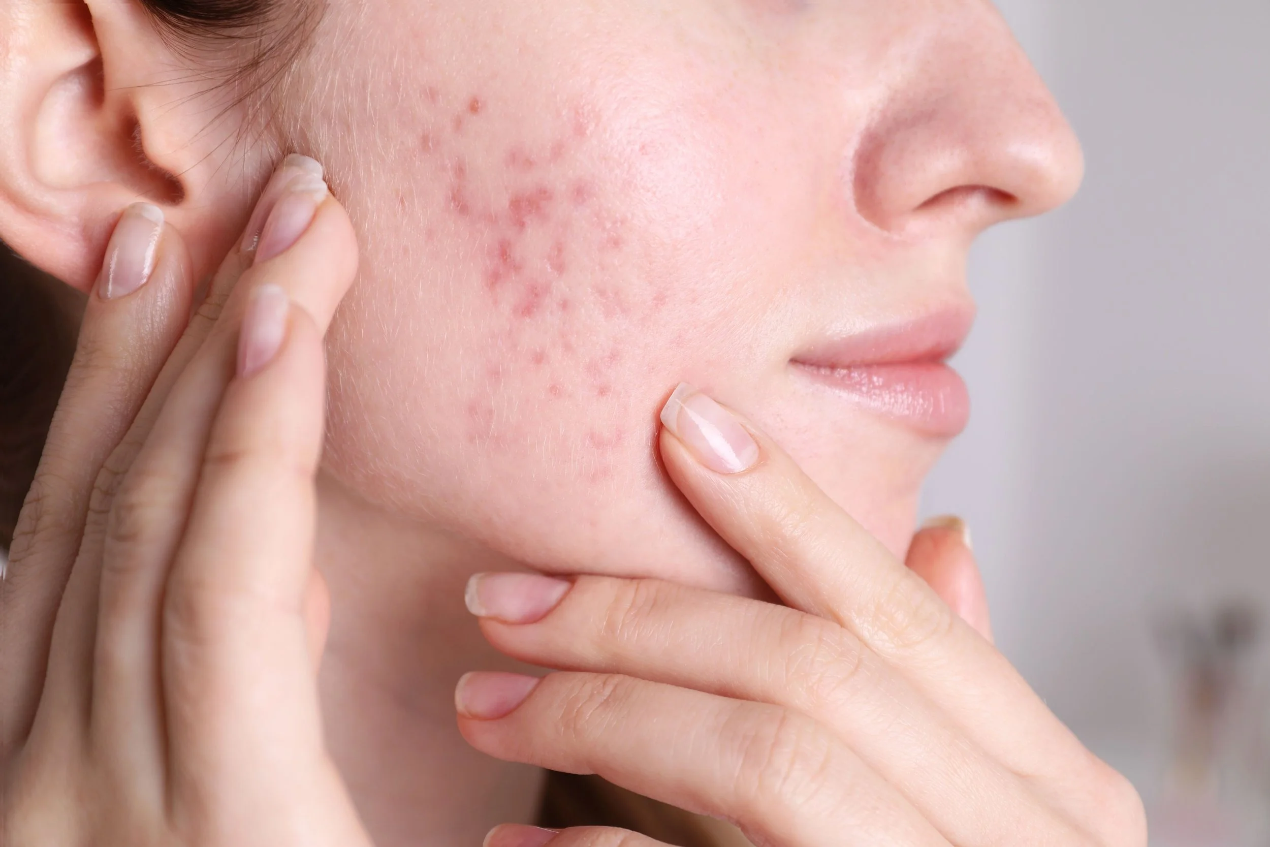 Acupuncture &amp; hormonal acne