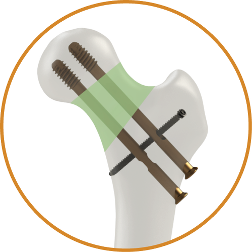 simplifix-procedure-stabilizortho