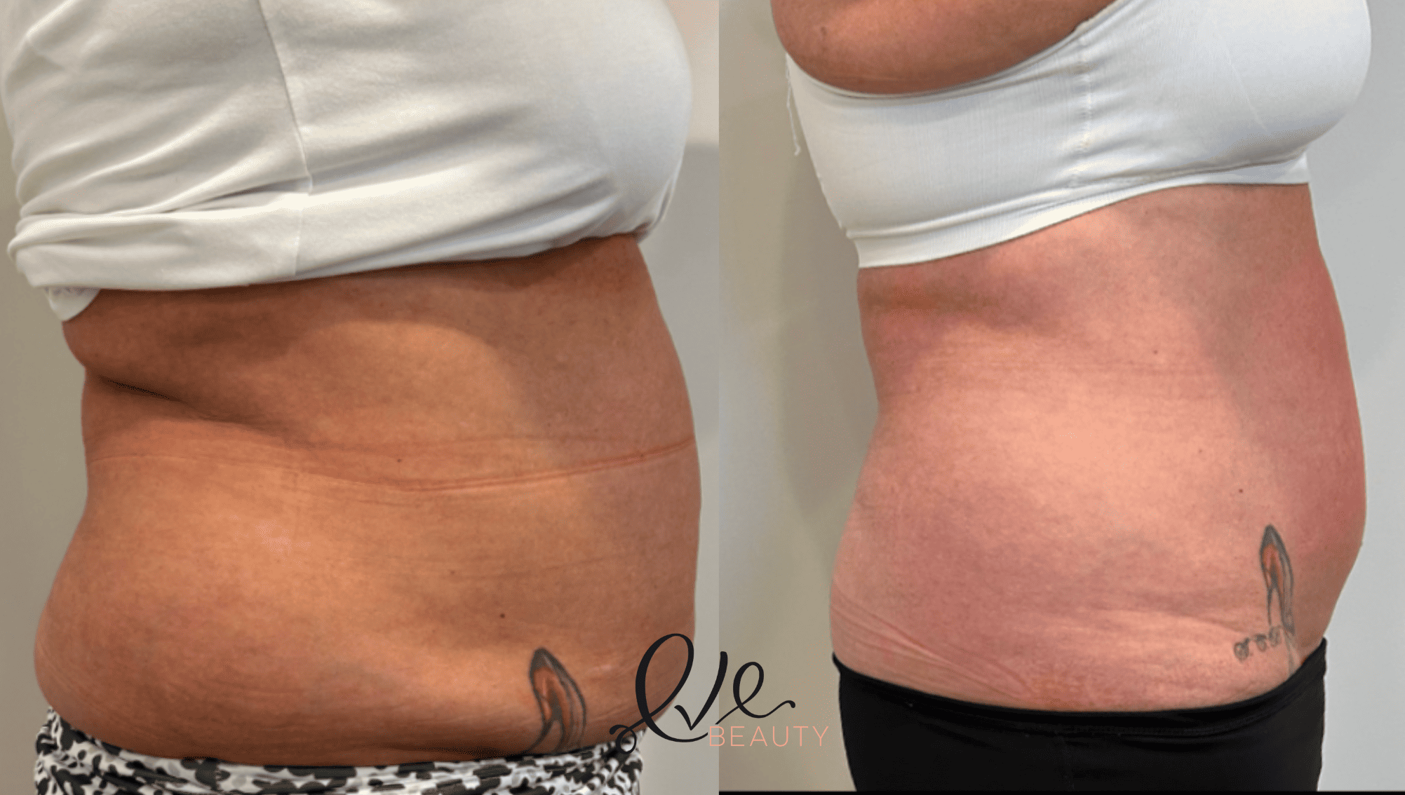 Transform Your Body Non-Invasive Laser Lipo — Eve Beauty