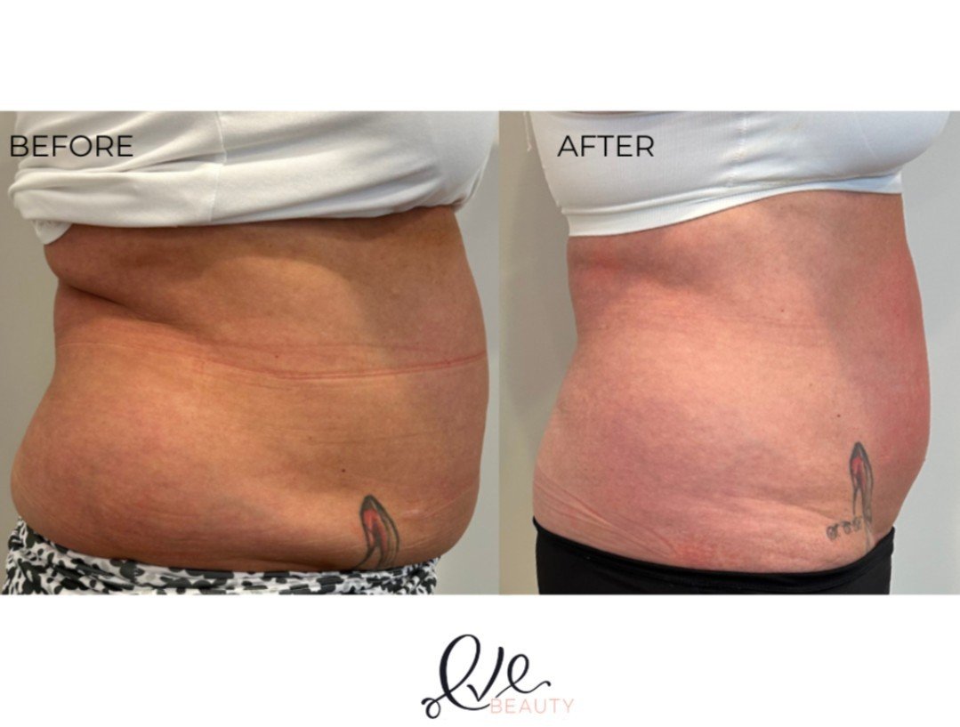 SURGERY - LIKE RESULTS WITH NO DOWNTIME, NON INVASIVE, COMFORTABLE AND RELIABLE! BOOK YOUR FREE CONSULTATION WITH US TODAY AND SEE WHAT LASER LIPOLYSIS IS ALL ABOUT AND HOW IT CAN TRANSFORM YOUR BODY!  Begin today with your first session for only $99