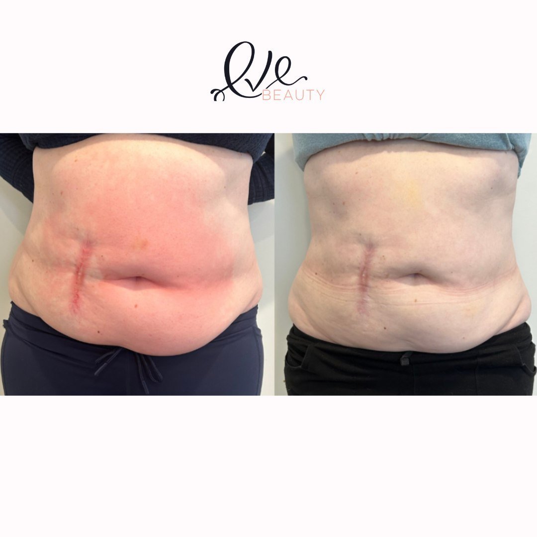 Ready to sculpt your dream body? Laser Lipolysis is your secret weapon! 🔥 Say goodbye to stubborn fat and hello to a sleeker silhouette. Our introductory session is your ticket to transformation - for just $99, embark on your journey with a full MP2