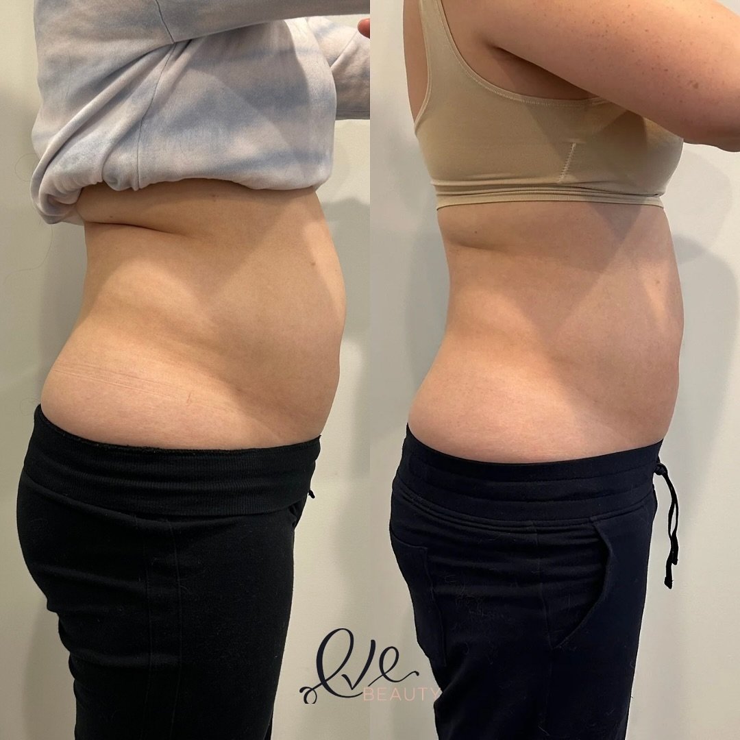 4 Inches Down since February 14th 💕 Laser Lipo and Mp2 Treatment  plan targeting the abdomen and we just began with the flanks. Stay tuned to see our final results. @venus.aesthetic.intelligence @venustreatments @evebeautyma 

Book a free consultati