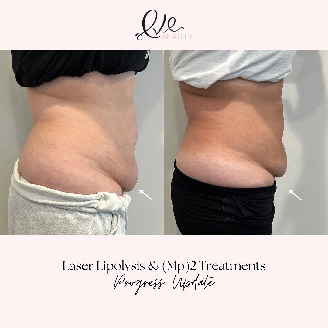 This transformation is going to change your opinion on noninvasive fat reduction. Stay tuned, we are making progress every week! 

Yes it&rsquo;s possible to lose actual inches with laser lipo ! 
Yes it&rsquo;s possible to tighten lose skin with lase