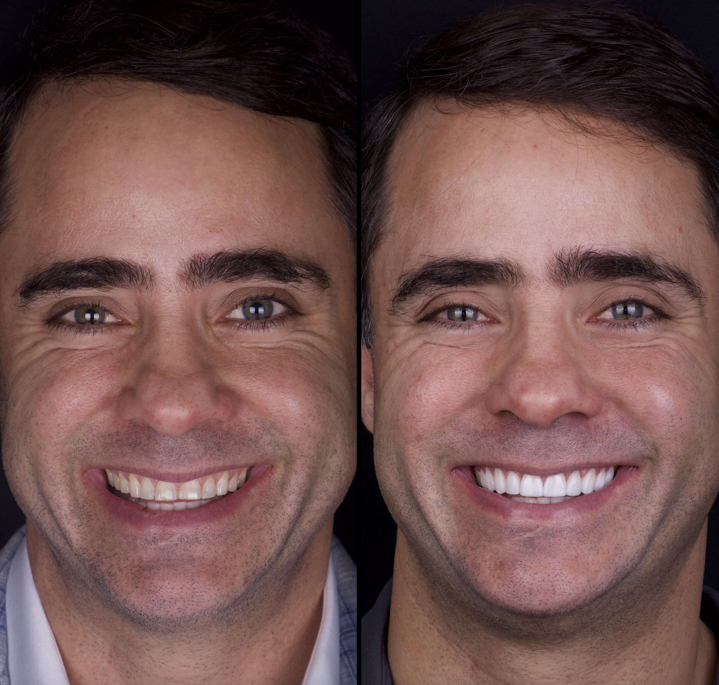 Carillas Dentales en  Monterrey