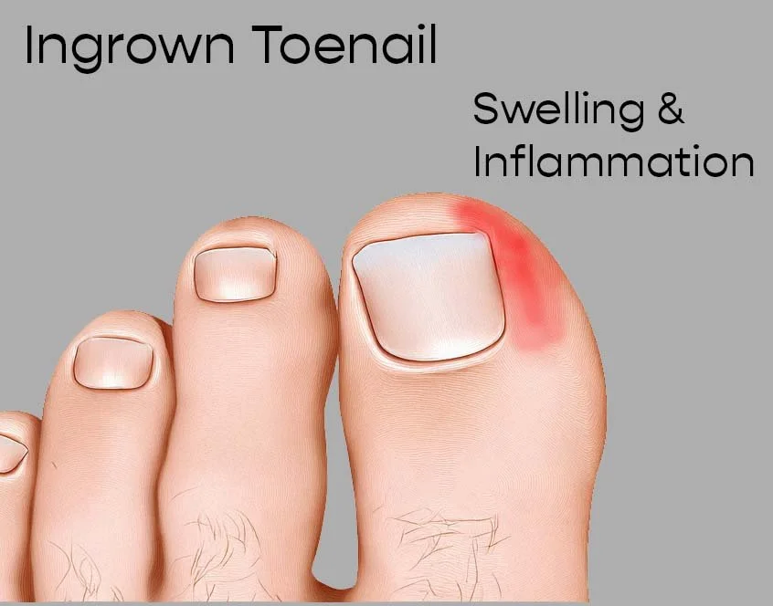 Ingrown toenail of big toe