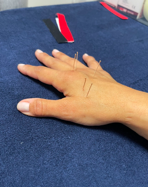 Dry Needling