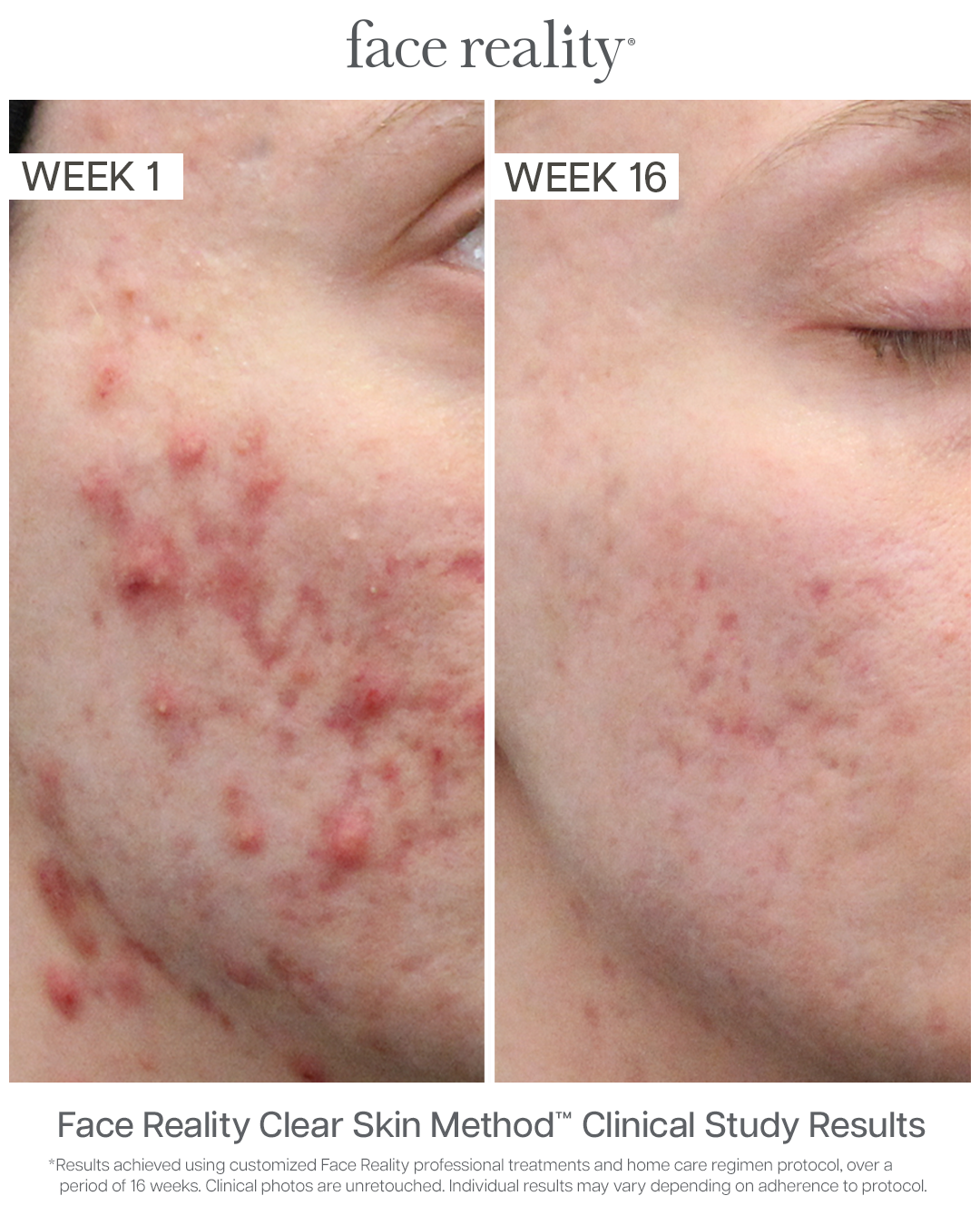 Hormonal Acne Treatment