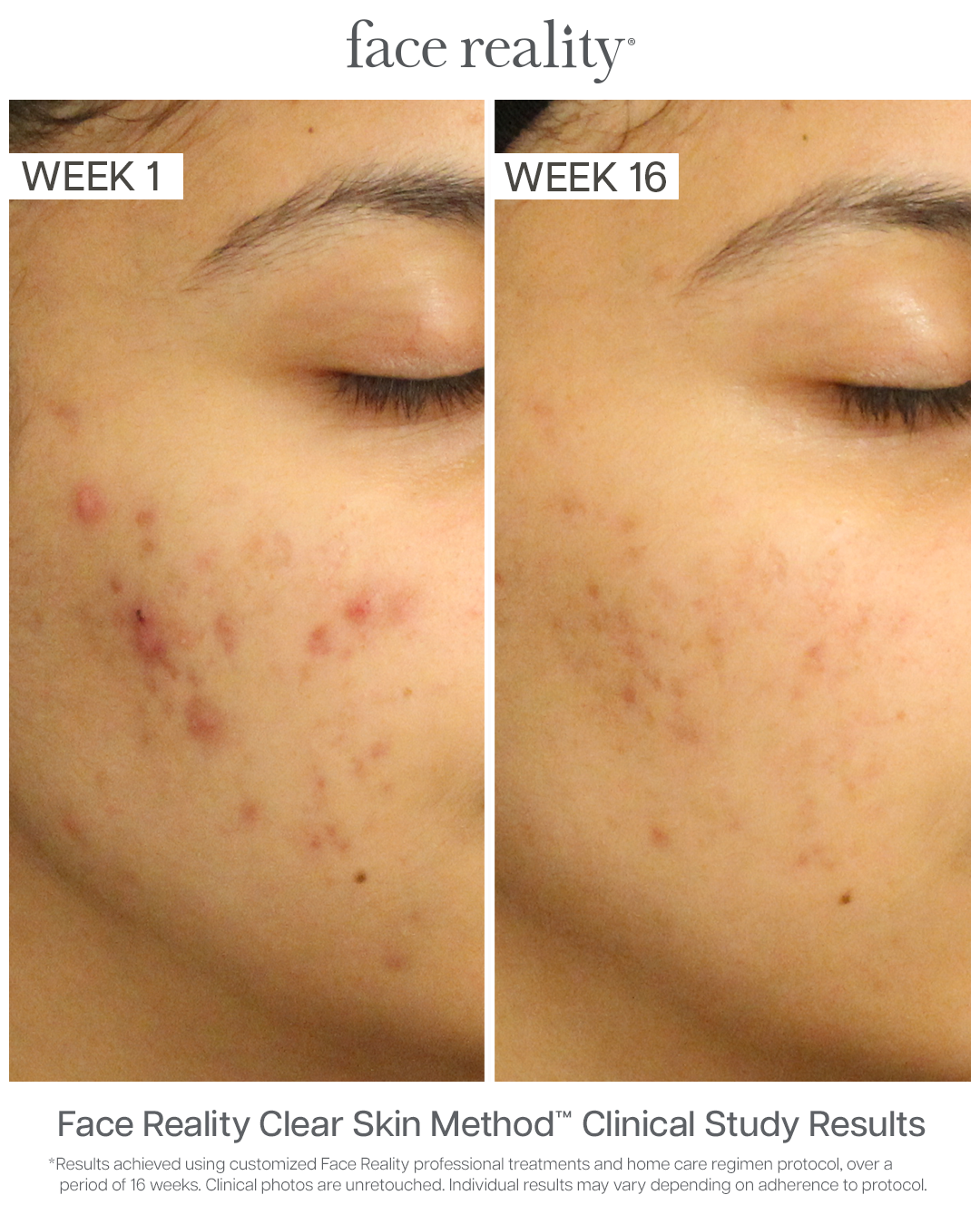 Acne Treatment Near Me
