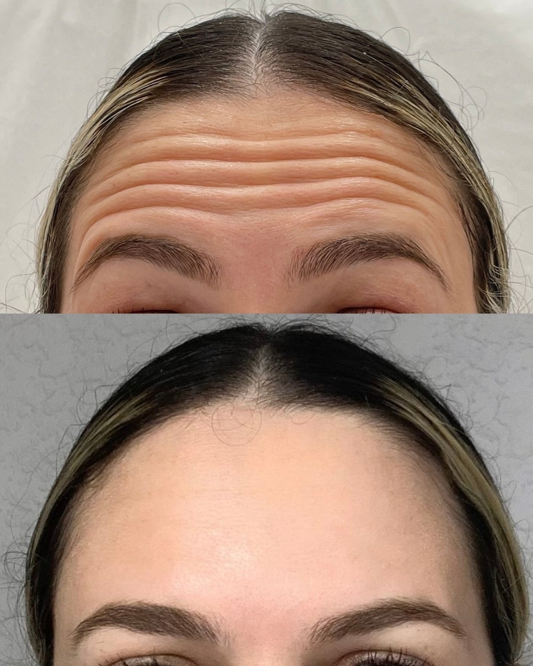 📷 Before and After: Botox Edition 🙌

Botox isn&rsquo;t just about looking younger, it&rsquo;s about feeling more confident and comfortable in your own skin. It&rsquo;s about enhancing your natural beauty and embracing your unique features. 💁&zwj;♀