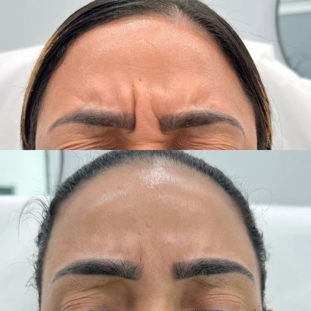 Still smooth&hellip; 5 months later 👀✨

This is your sign 💉
Our after photo was taken 5 months after Jeuveau and those results are STILL going strong 🙌

✔️ Softer lines
✔️ Smoother skin
✔️ Natural, refreshed look 

📍Cape Coral, FL 
Located inside