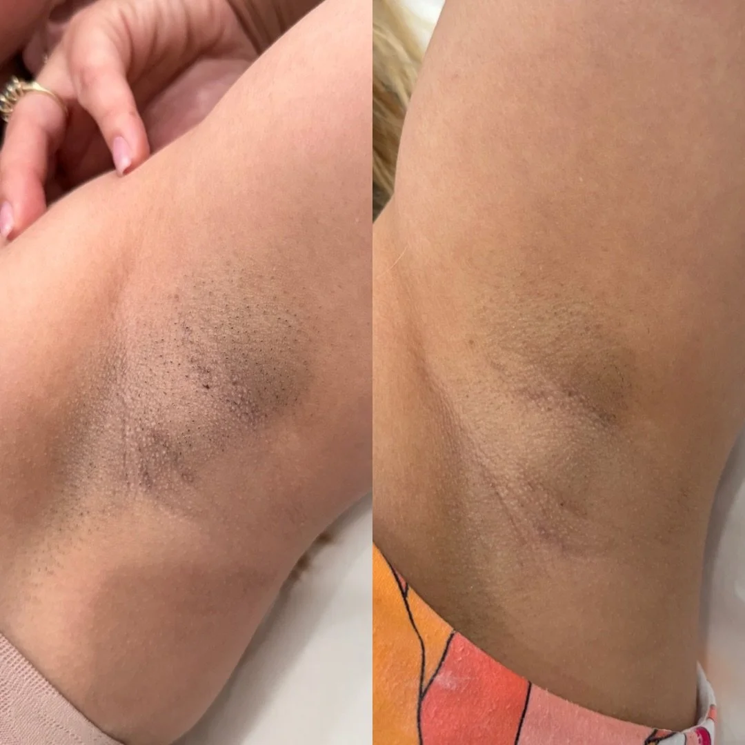 Smooth underarms after just ONE session? Yes, it&rsquo;s possible ✨

This before &amp; after shows a noticeable reduction in hair + a visible improvement in skin tone. 
Less shadow, less irritation 💖

Imagine what a full series can do 👀🔥

Ready to