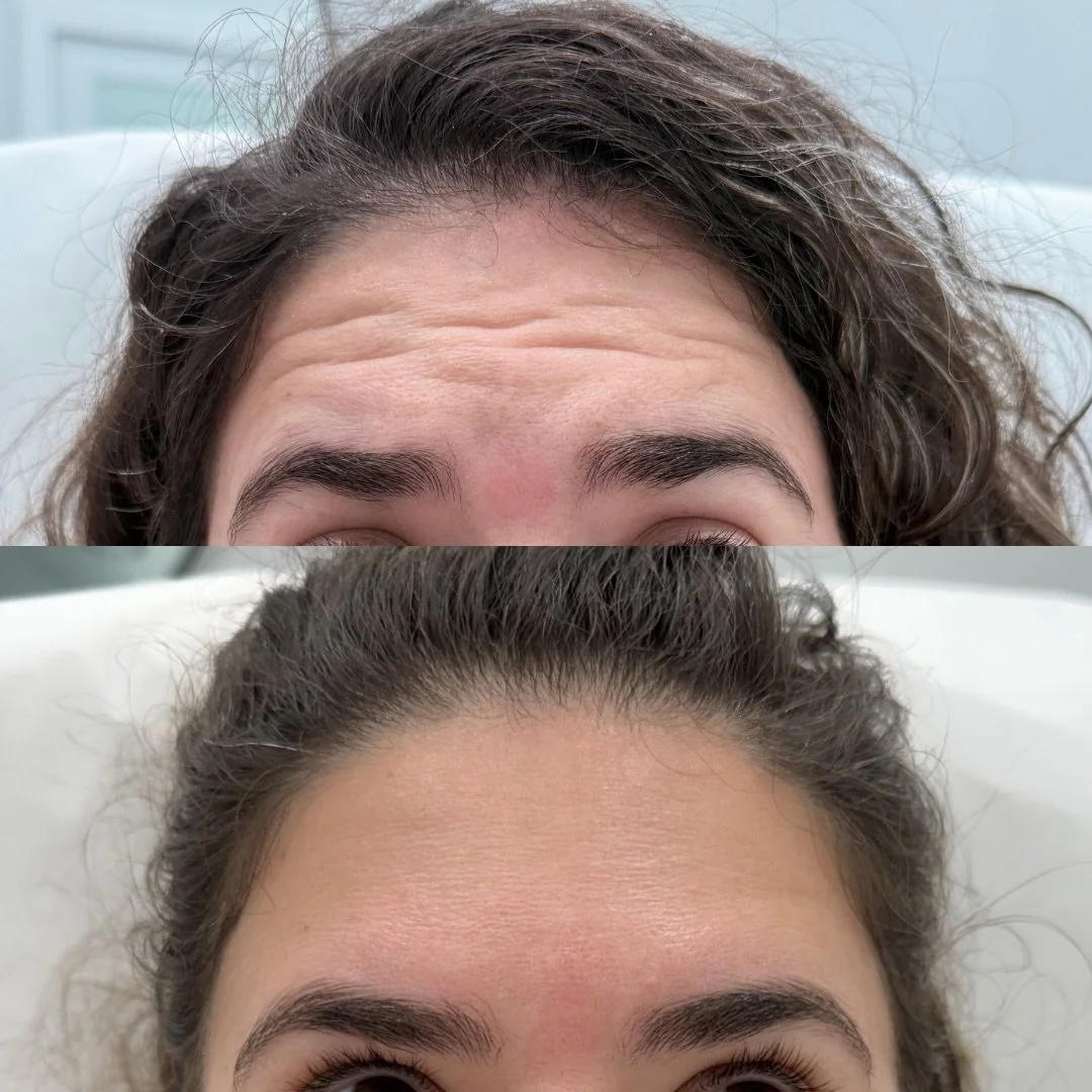 2 weeks later&hellip; ✨💉

Jeuveau working its magic on those fine lines 👀

Book your appointment ⬇️

📍Cape Coral, FL 
Located inside Society Salon Suites 

Or contact us for more info 
📞 (239)822-2000
🗓️ Visit booking link on bio 
📧 info@cgaest