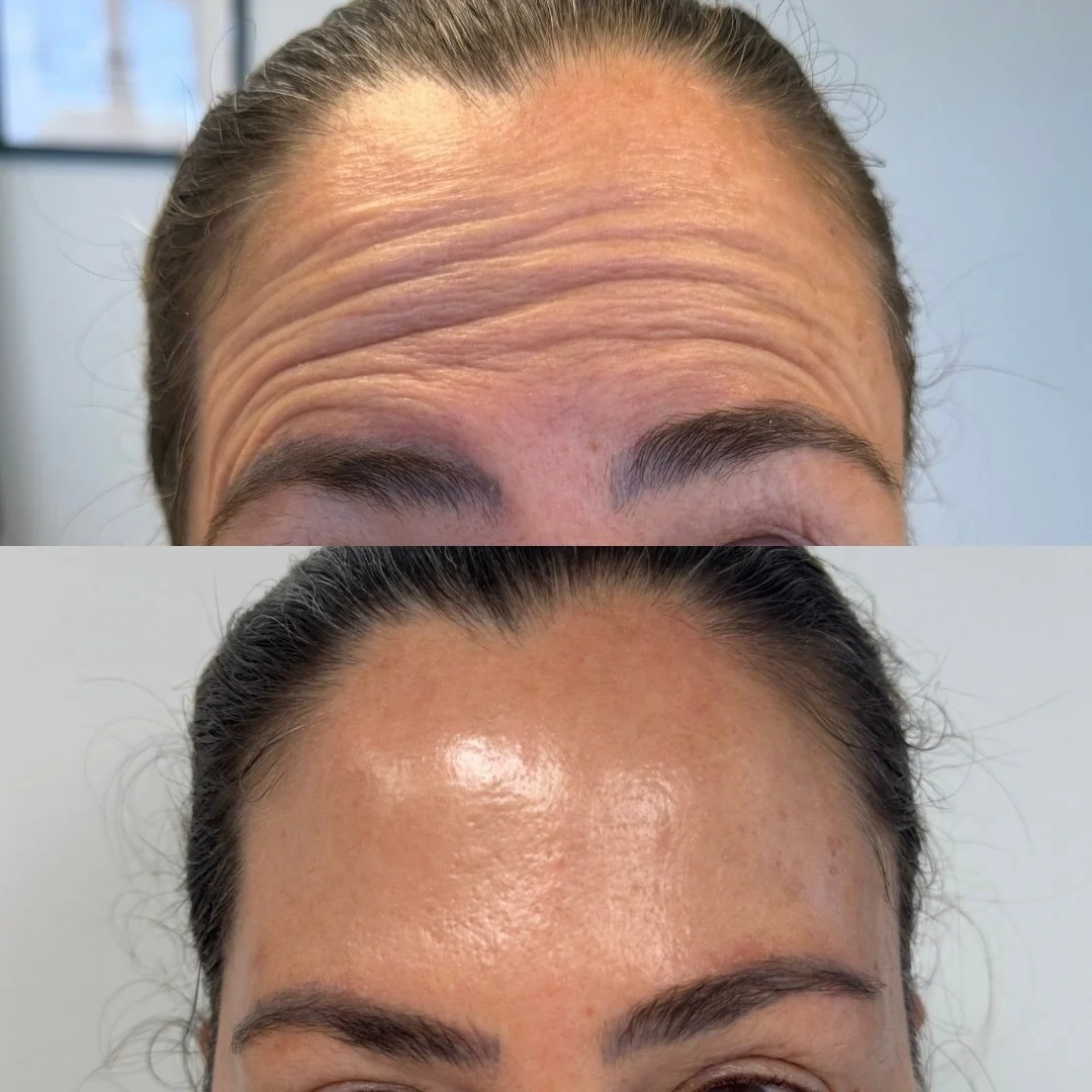 No filter. No touch-up. Just Daxxify at 2 weeks 🔥
Even the hard-to-treat brow lines? Taken care of 👏

This is your reminder that smooth, natural results are possible ✨

Book your appointment ⬇️

📍Cape Coral, FL 
Located inside Society Salon Suites