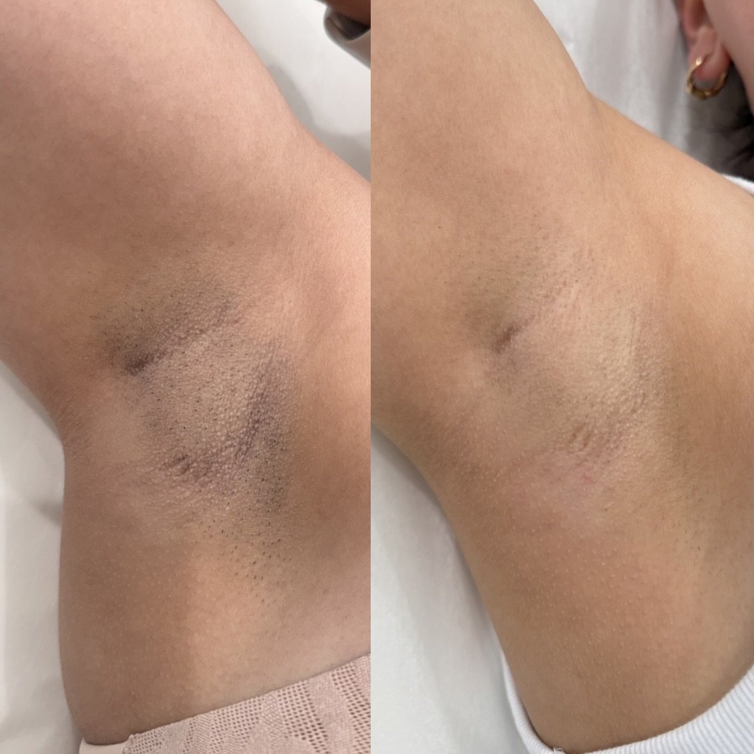 After just 3 sessions, the difference is undeniable&hellip; incredible hair reduction, finer regrowth, and improved skin tone 🙌

Book your appointment ⬇️

📍Cape Coral, FL 
Located inside Society Salon Suites 

Or contact us for more info 
📞 (239)8