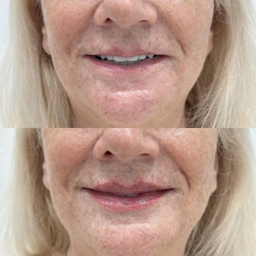 A touch of filler can make all the difference &mdash; just 0.5 mL gave this beautiful patient noticeable hydration, improved lip texture, and a refreshed look.

Sometimes less truly is more 🤍

Book your appointment ⬇️

📍Cape Coral, FL 
Located insi