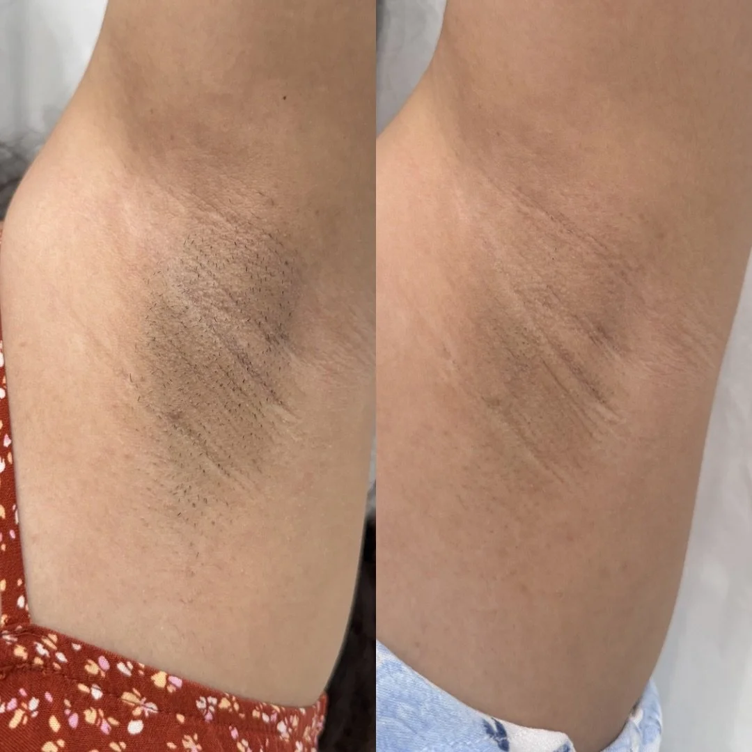 Another happy client seeing amazing hair reduction after laser hair removal 🙌🏼

Ready to start your laser journey?🤍

Book your appointment ⬇️

📍Cape Coral, FL 
Located inside Society Salon Suites 

Or contact us for more info 
📞 (239)822-2000
🗓