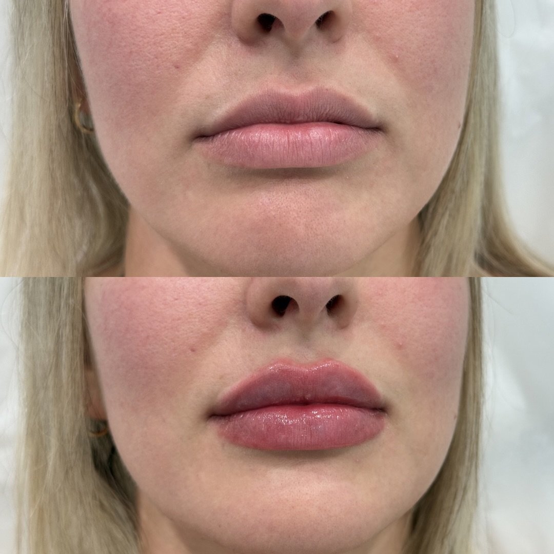 Soft volume and balanced shape

This lip filler transformation added hydration, definition, and fullness 💋

Results achieved with 0.6 mL 

📩 DM us to book your lip filler consultation

📍Cape Coral, FL 
Located inside Society Salon Suites 

Or cont