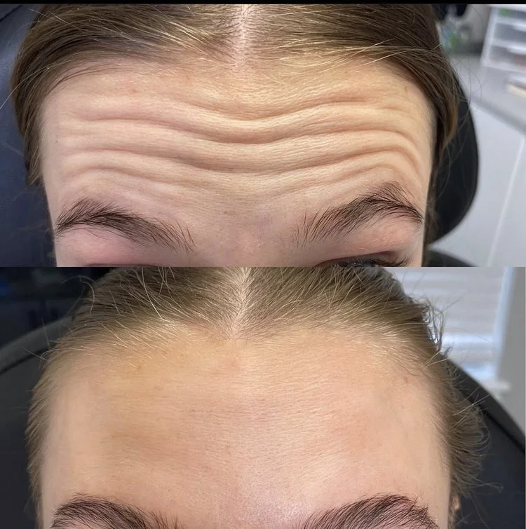 botox1.jpeg