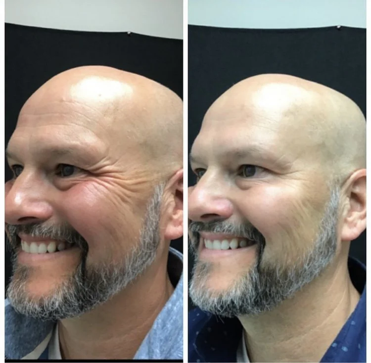 botox5.jpeg