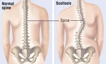 Scoliosis Assumptions