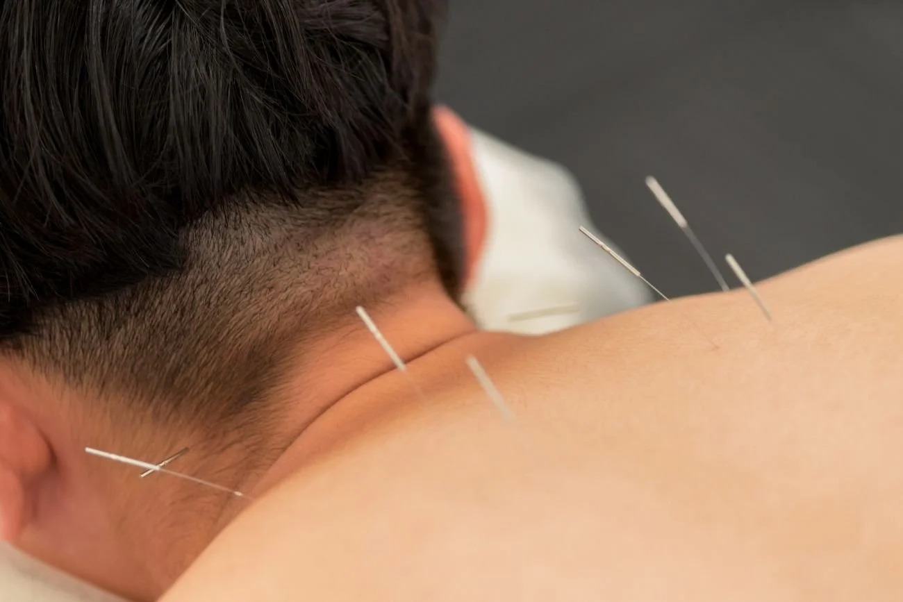 acupuncture for fibromyalgia fatigue relief