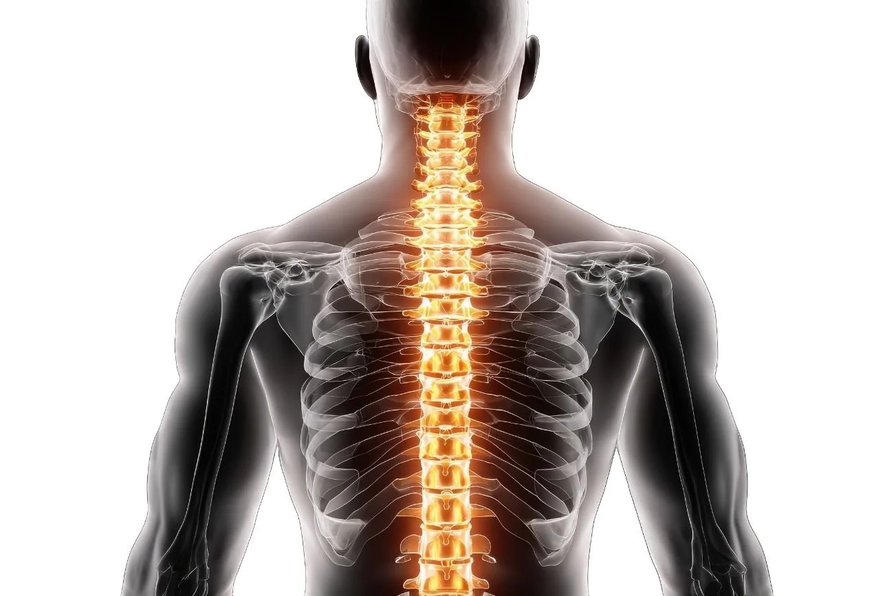 Spine diagram showing spinal stenosis