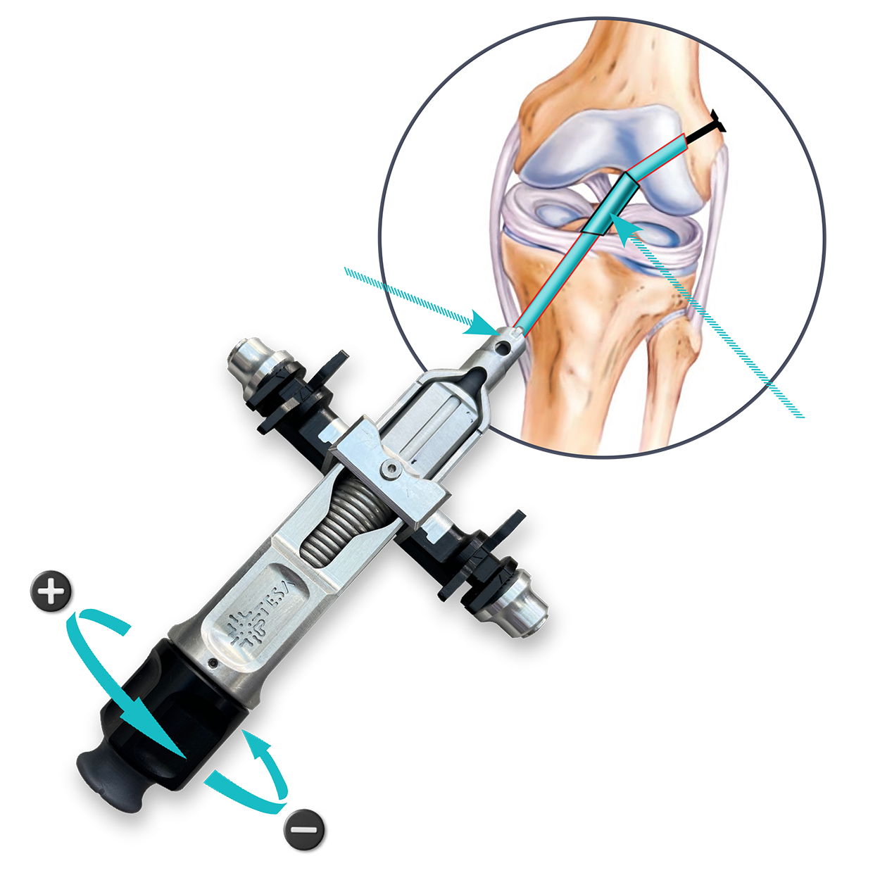 Medical illustration showing a needle injecting into a knee joint with a diagram of the knee anatomy, including bones, cartilage, and ligaments.