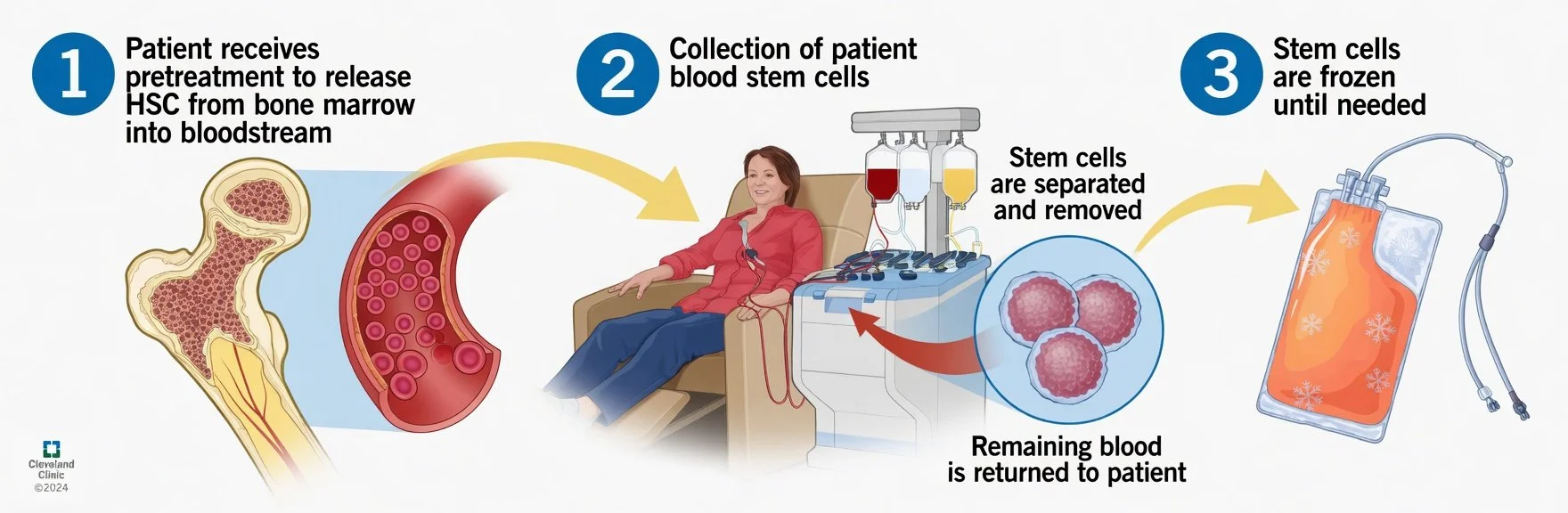 Three steps that are part of the stem cell harvesting and banking process.
