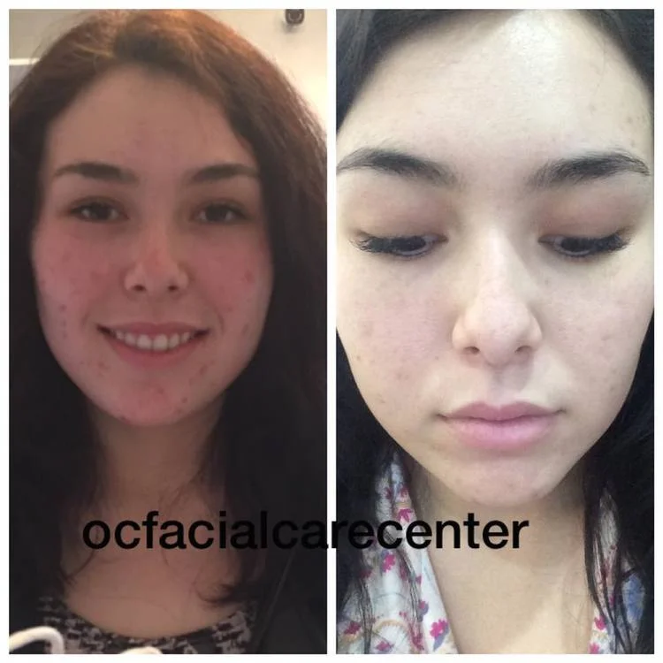 The Causes of Teen and Adult Acne