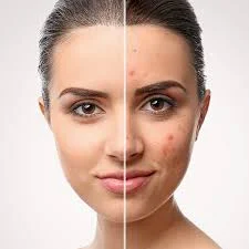 Acne Treatment with Obagi Medical