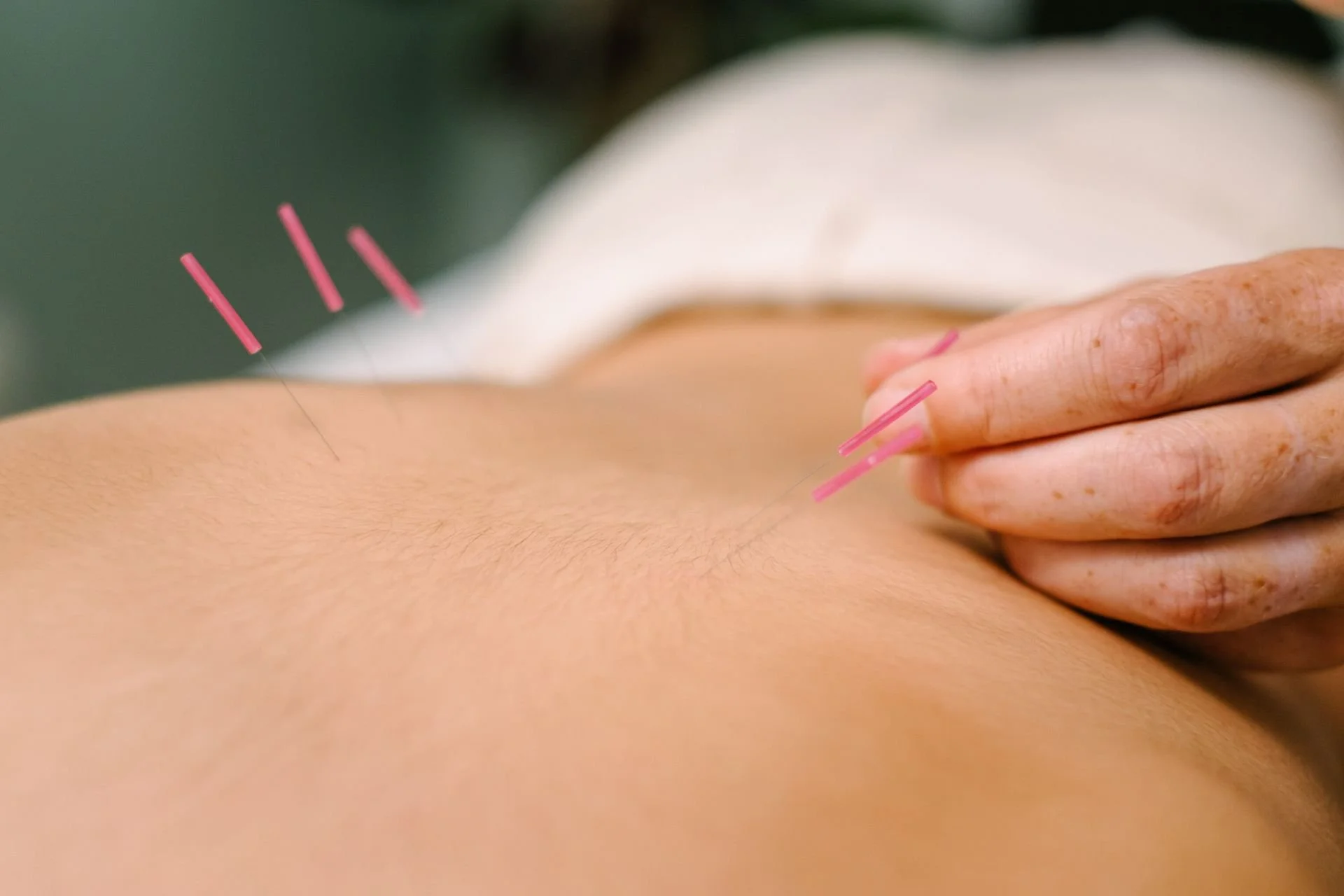 Acupuncture for fertility