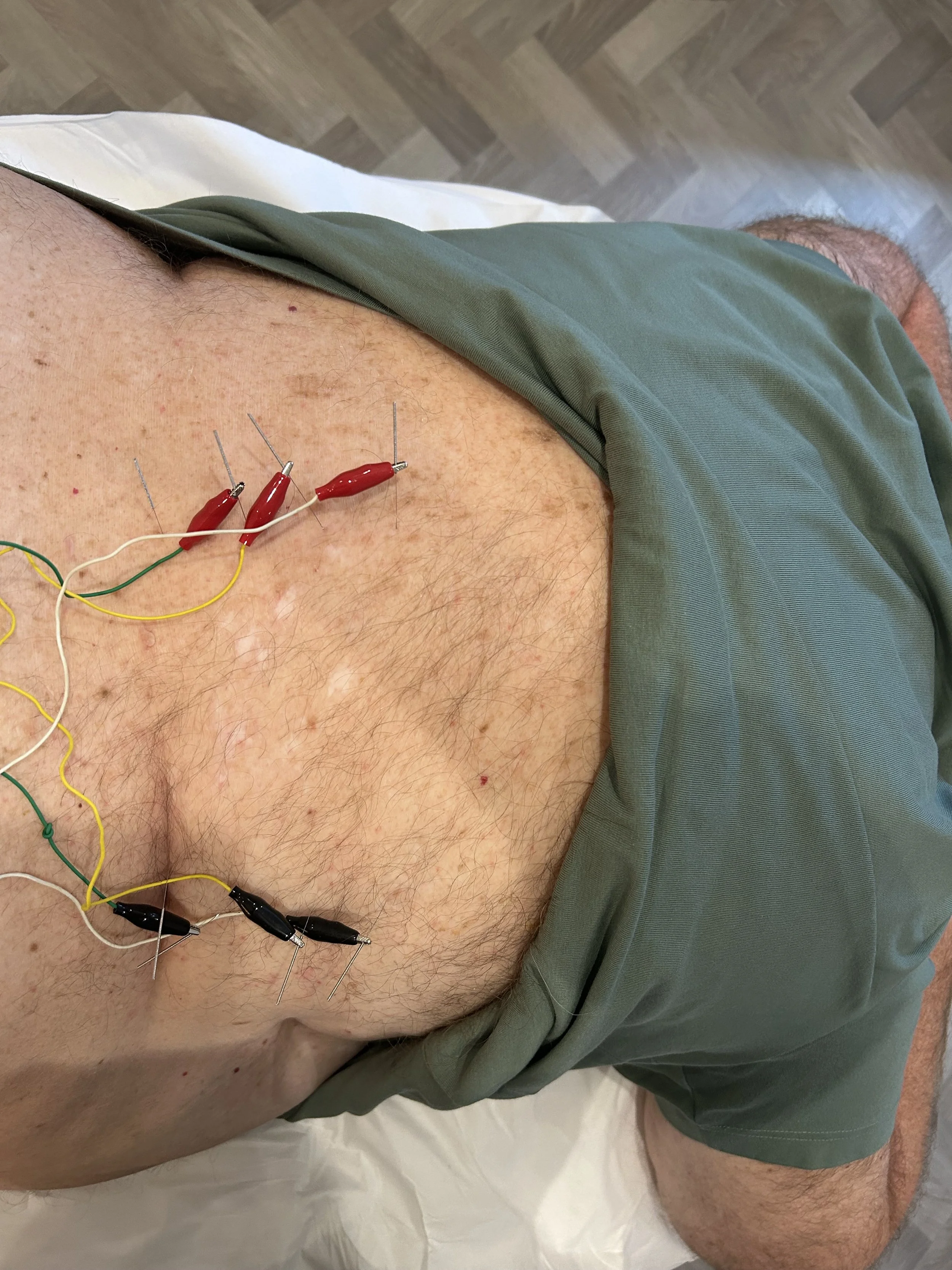 Electro-acupuncture for shingles pain
