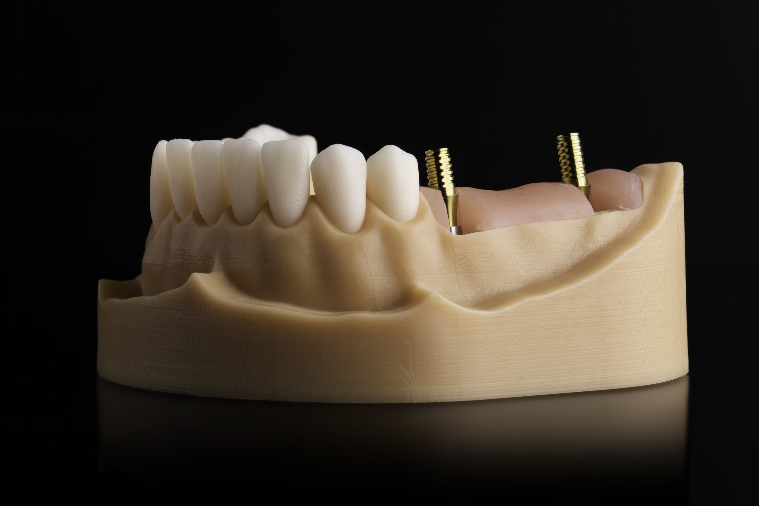 Componentistica implantare New Ancorvis