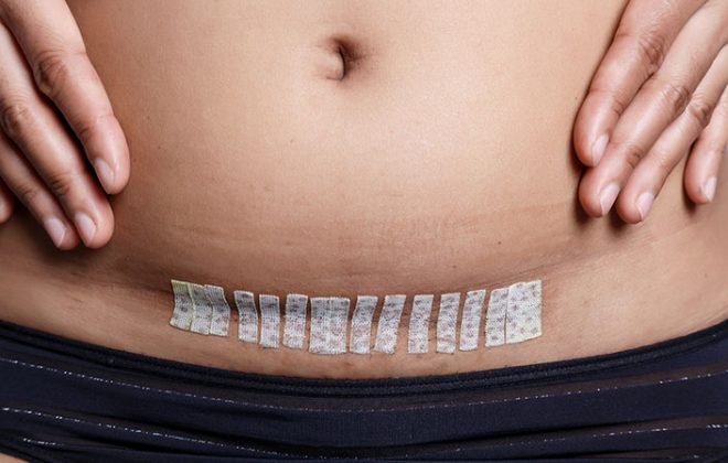 Caesarean Scar release