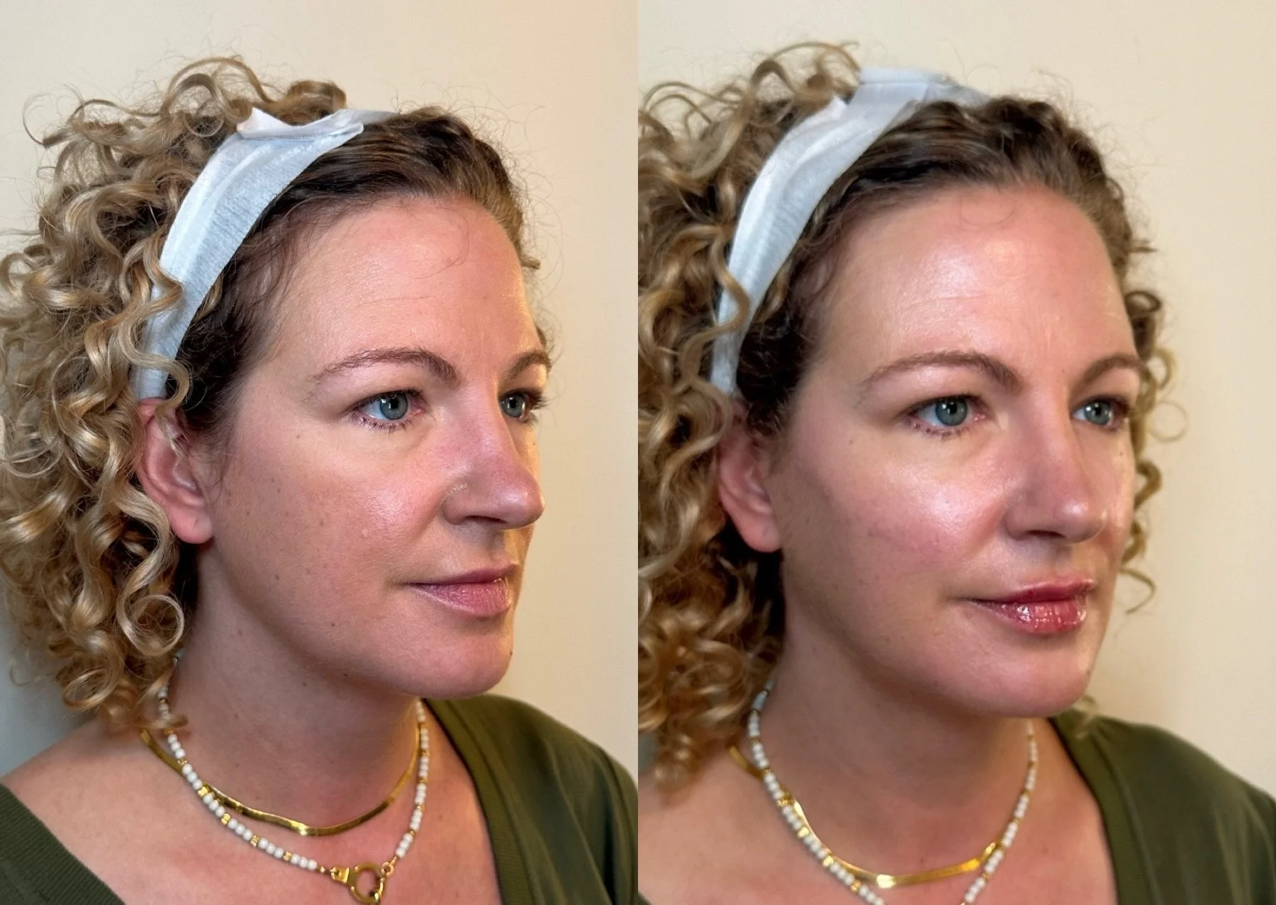 full facial balancing