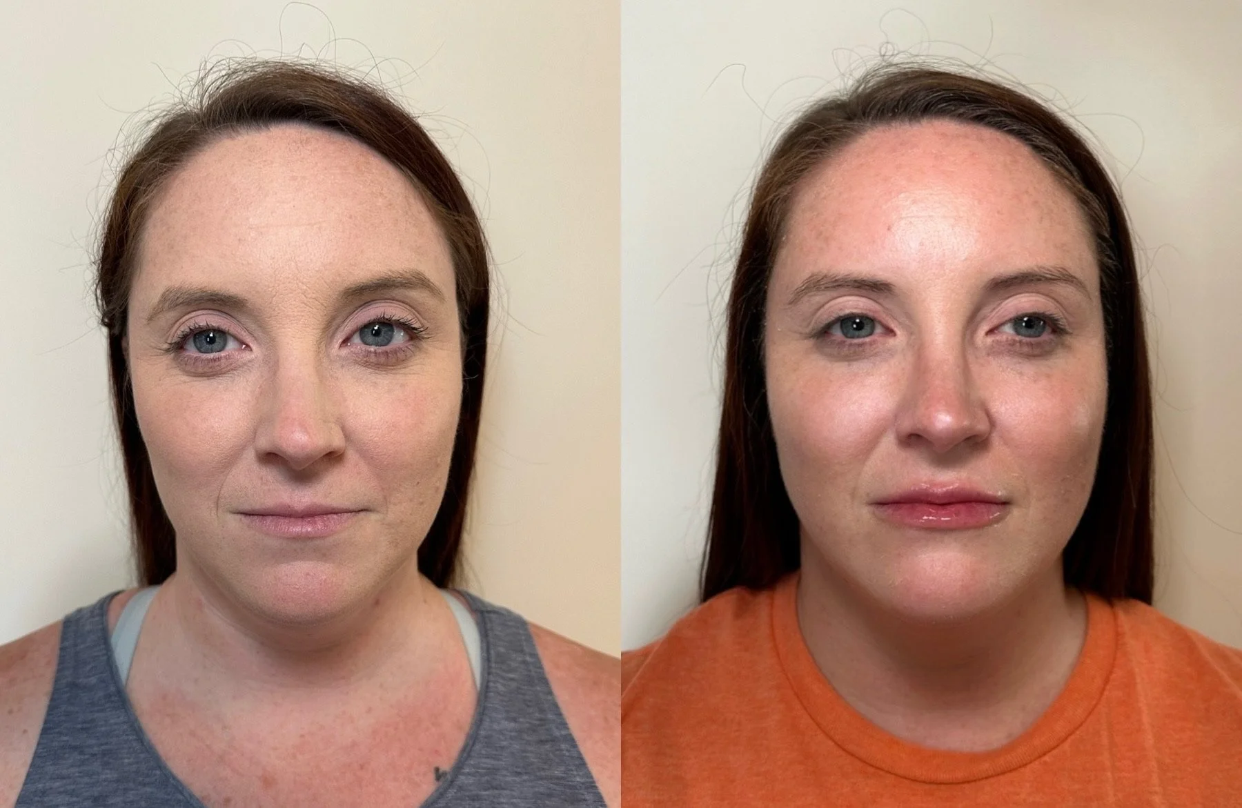 full facial balancing