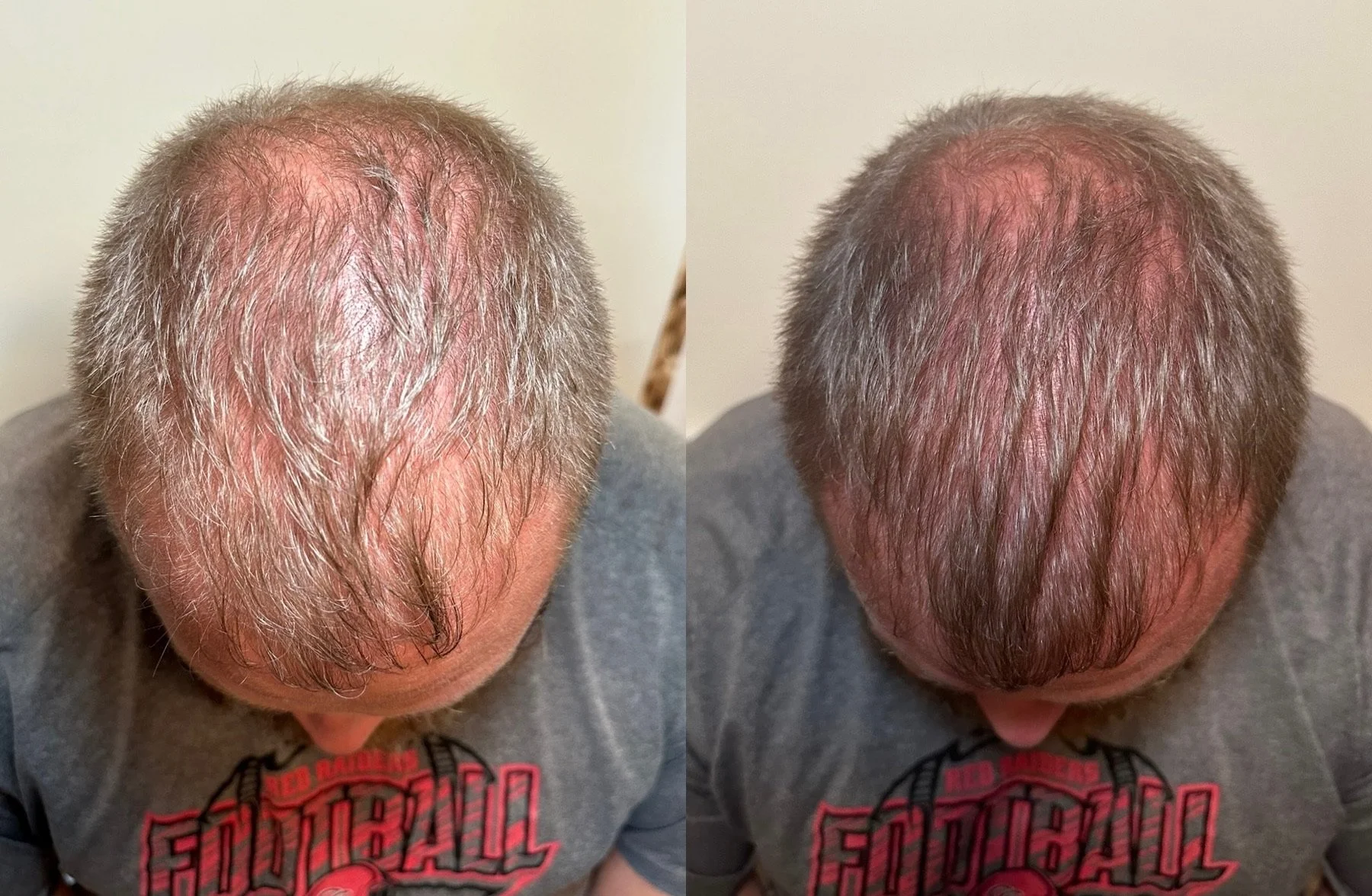 hair restoration