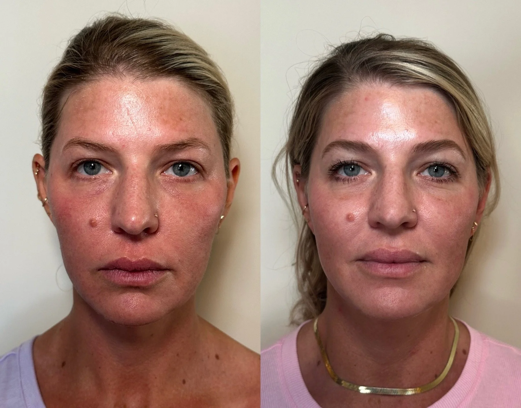 full facial balancing